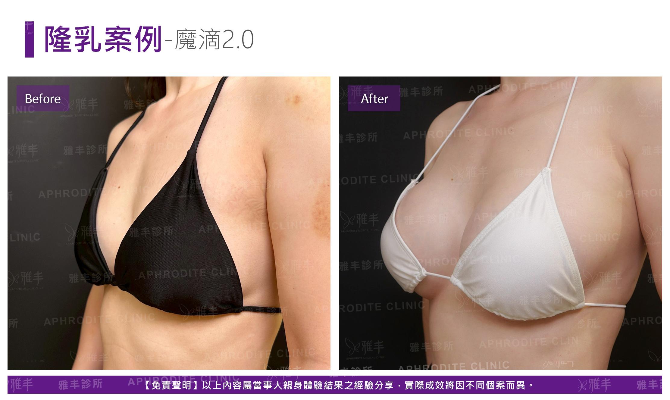 隆乳手術-case21-L45.jpg