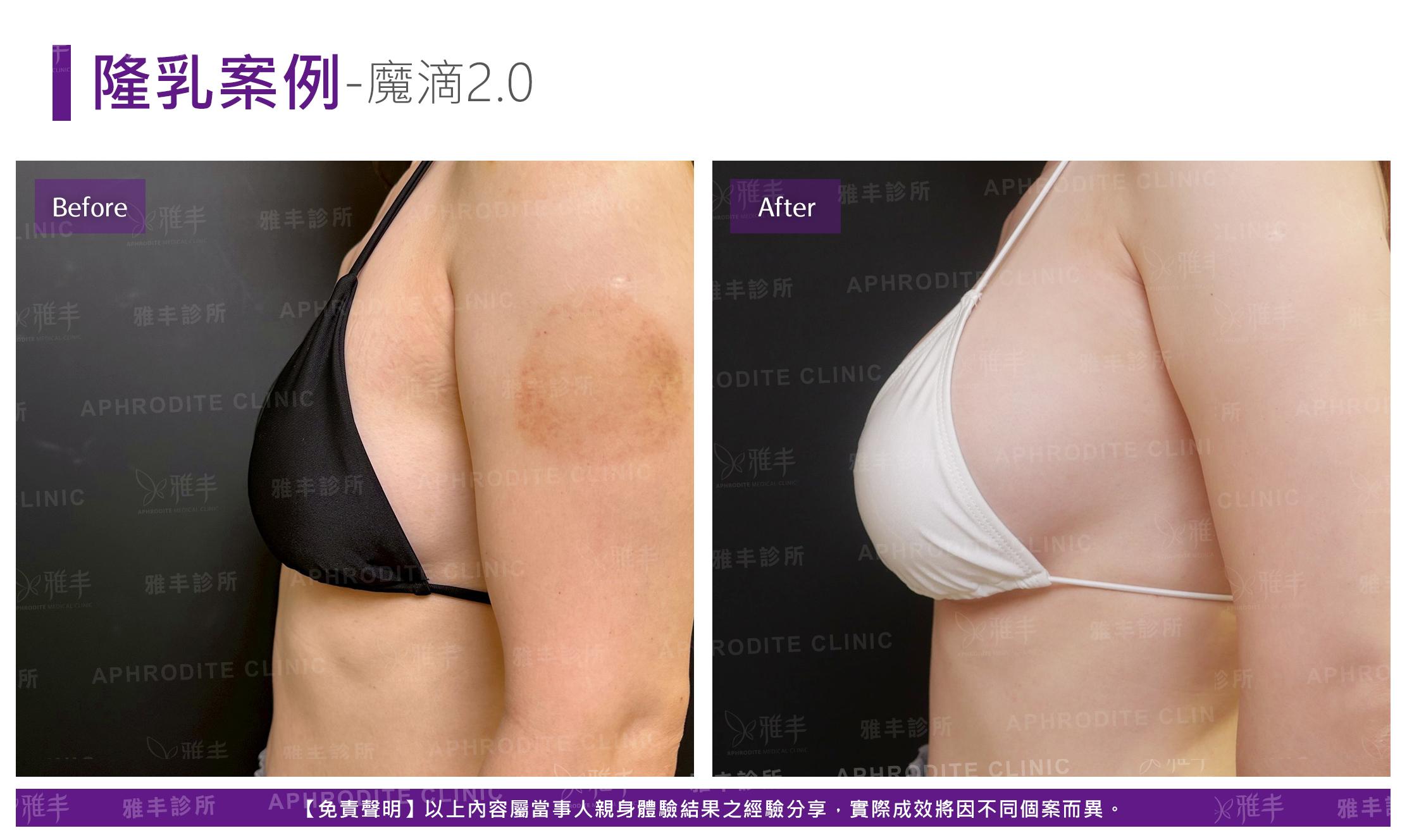 隆乳手術-case21-L90.jpg