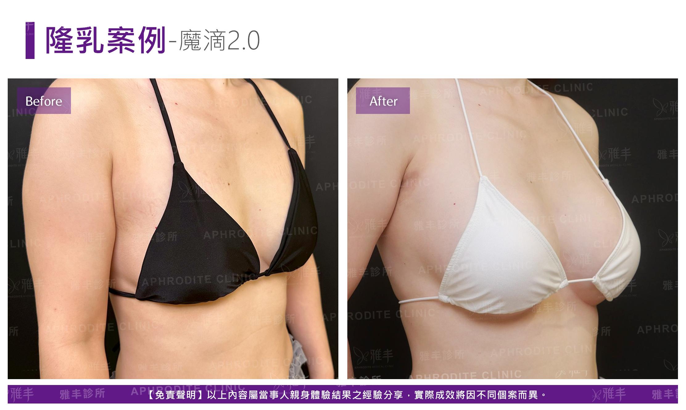 隆乳手術-case21-R45.jpg