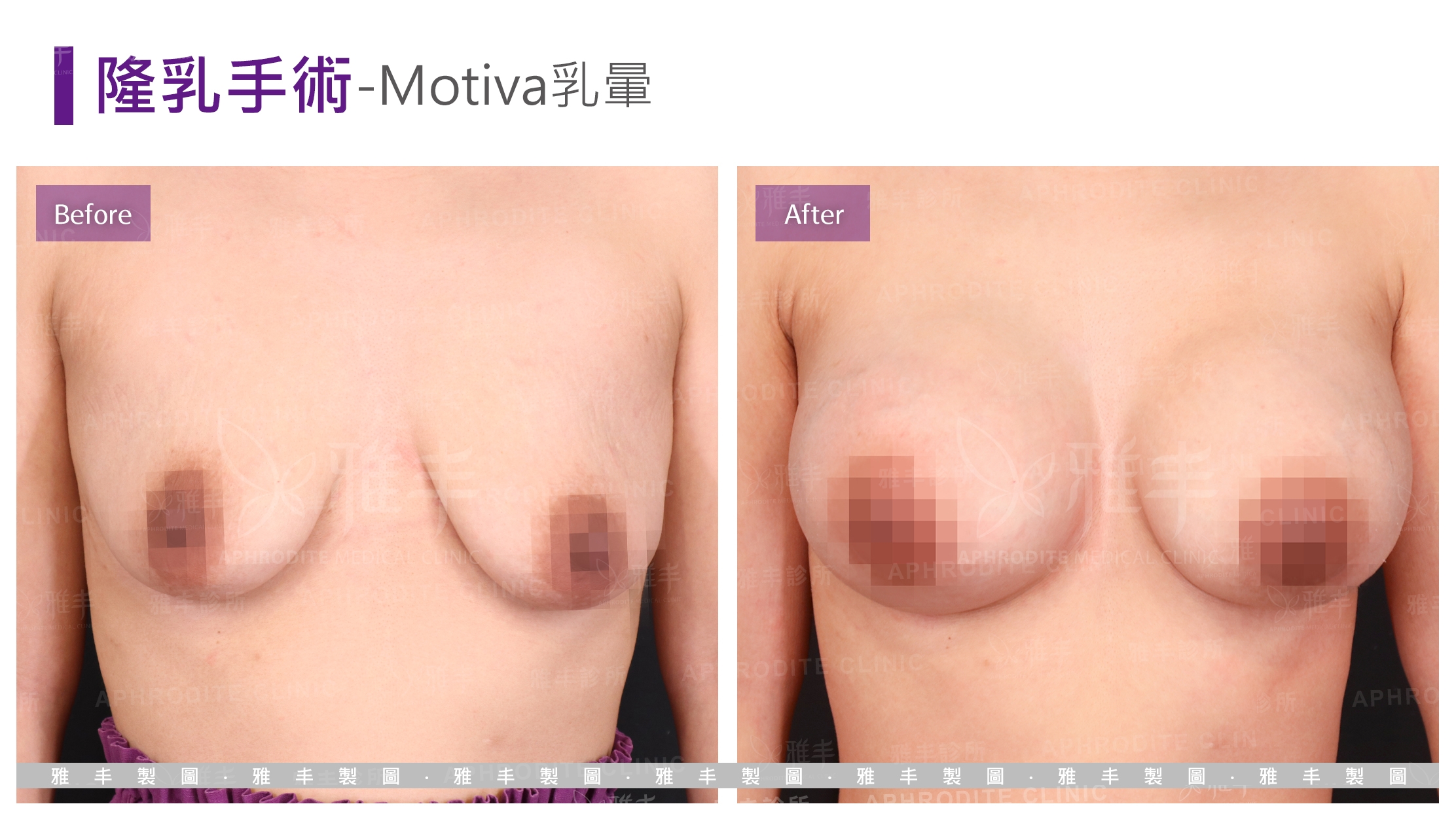 隆乳手術-Motiva乳暈(Case3)