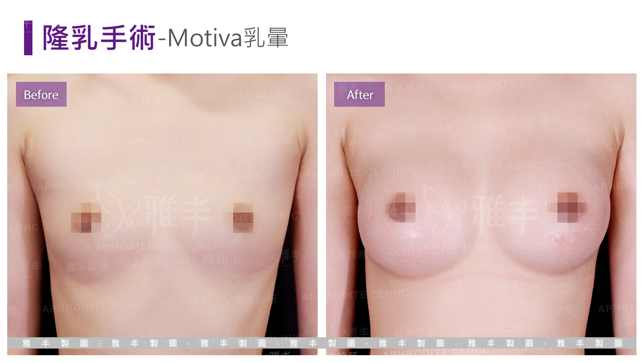 隆乳手術-Motiva乳暈(Case4)