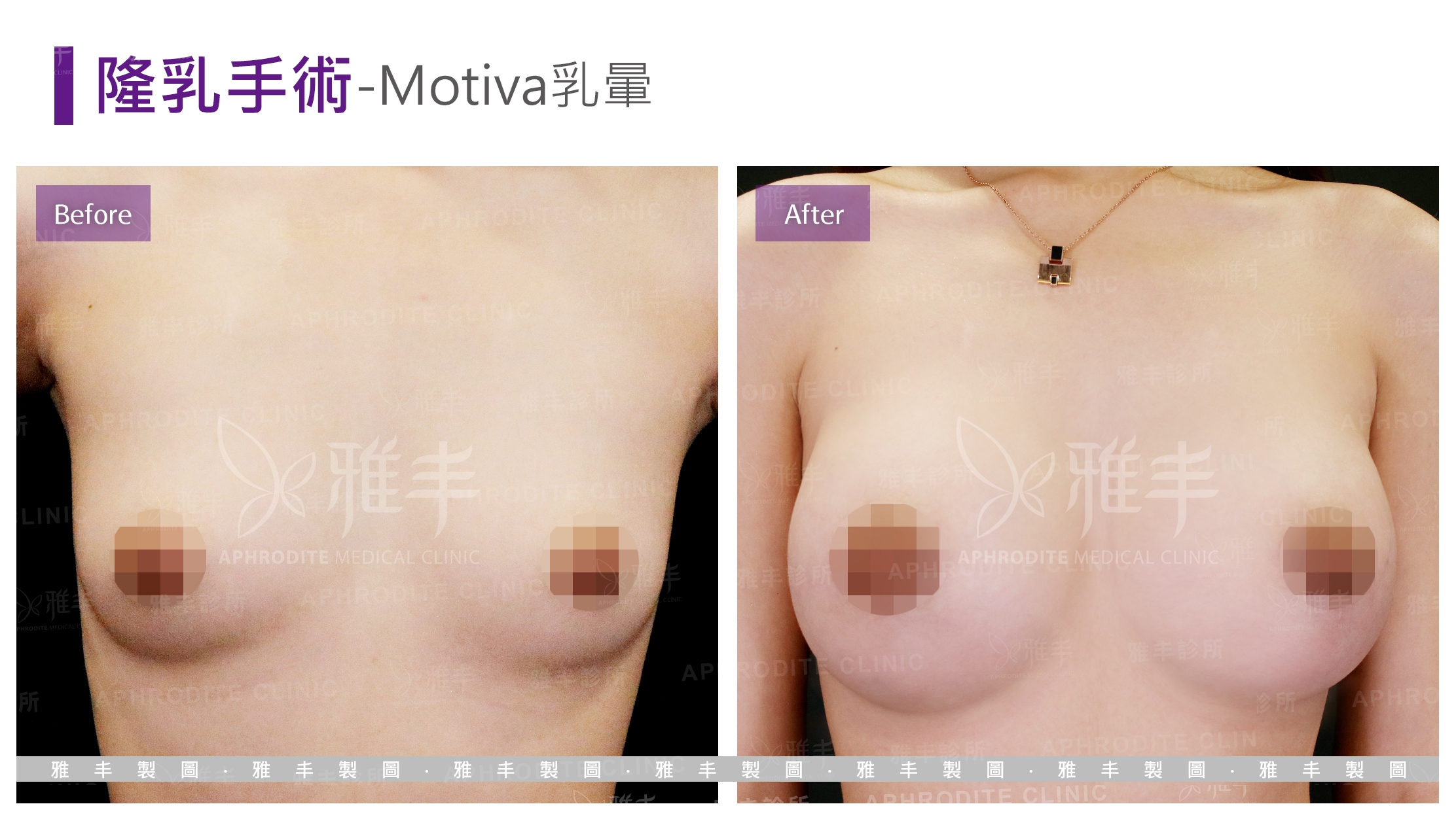 隆乳手術-Motiva乳暈(Case5)