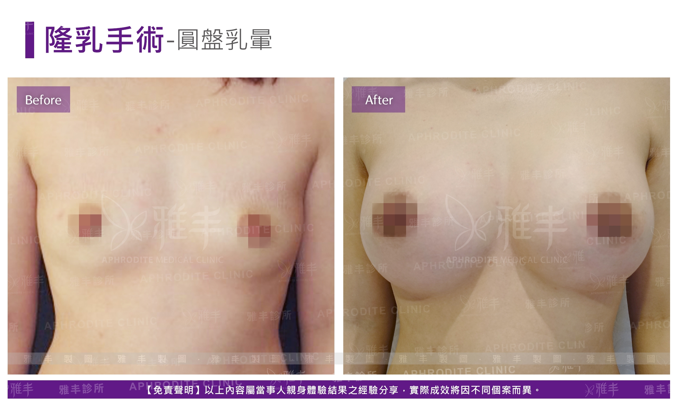 隆乳手術-圓盤乳暈(Case8)