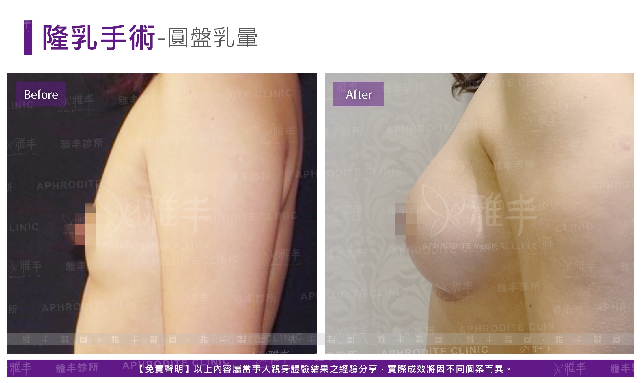 隆乳手術-圓盤乳暈(Case8-L90)