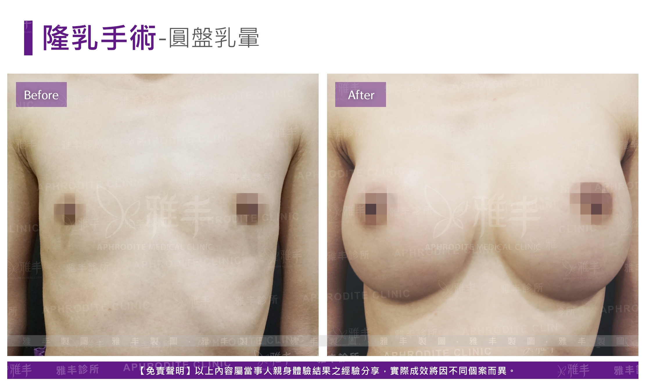隆乳手術-圓盤乳暈(Case9)
