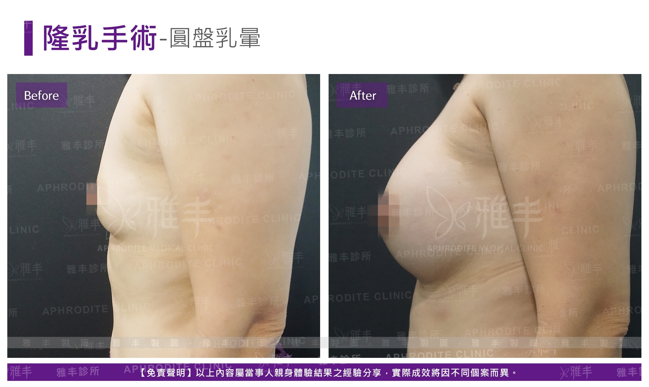 隆乳手術-圓盤乳暈(Case10-L90)