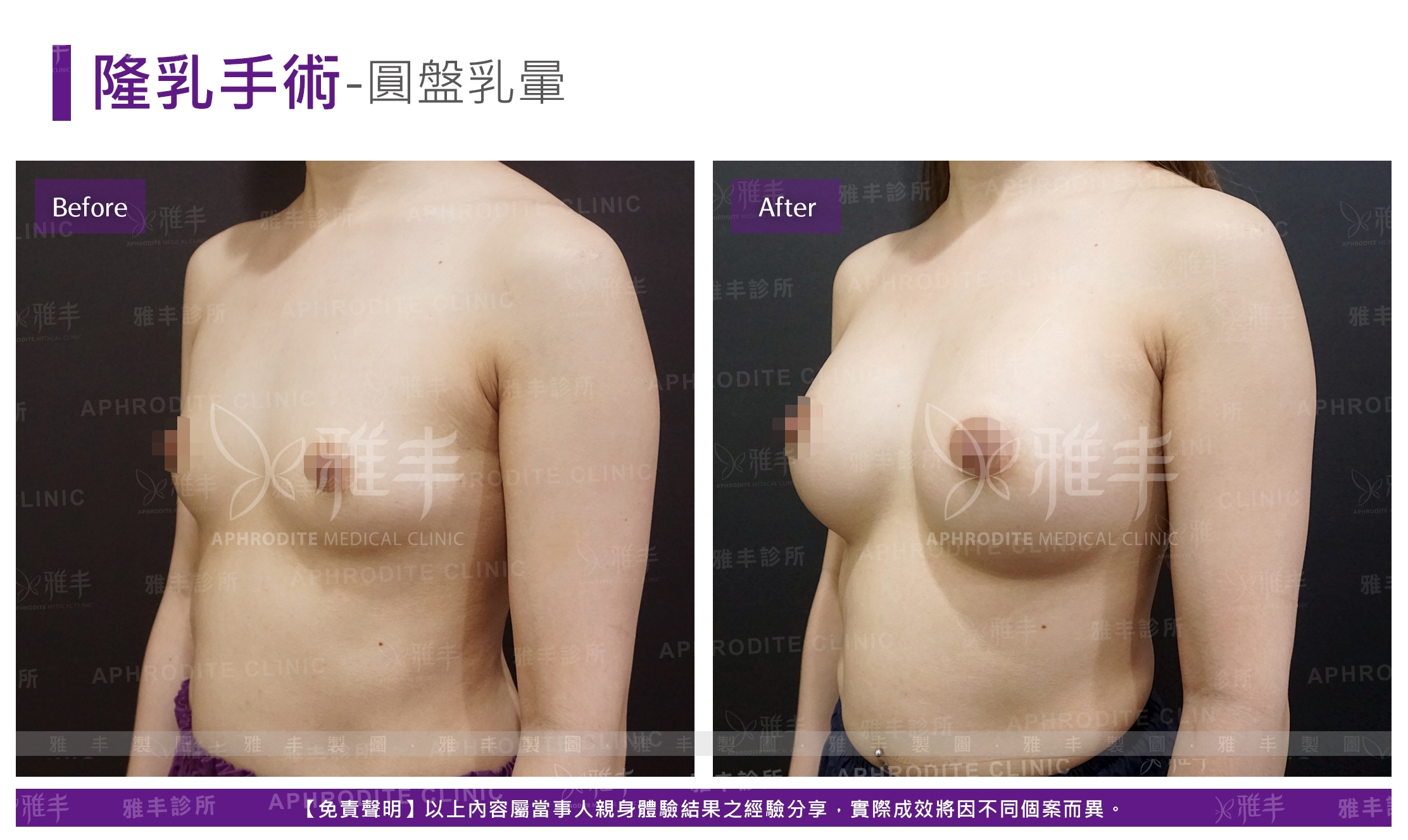 隆乳手術-圓盤乳暈(Case11-L45)