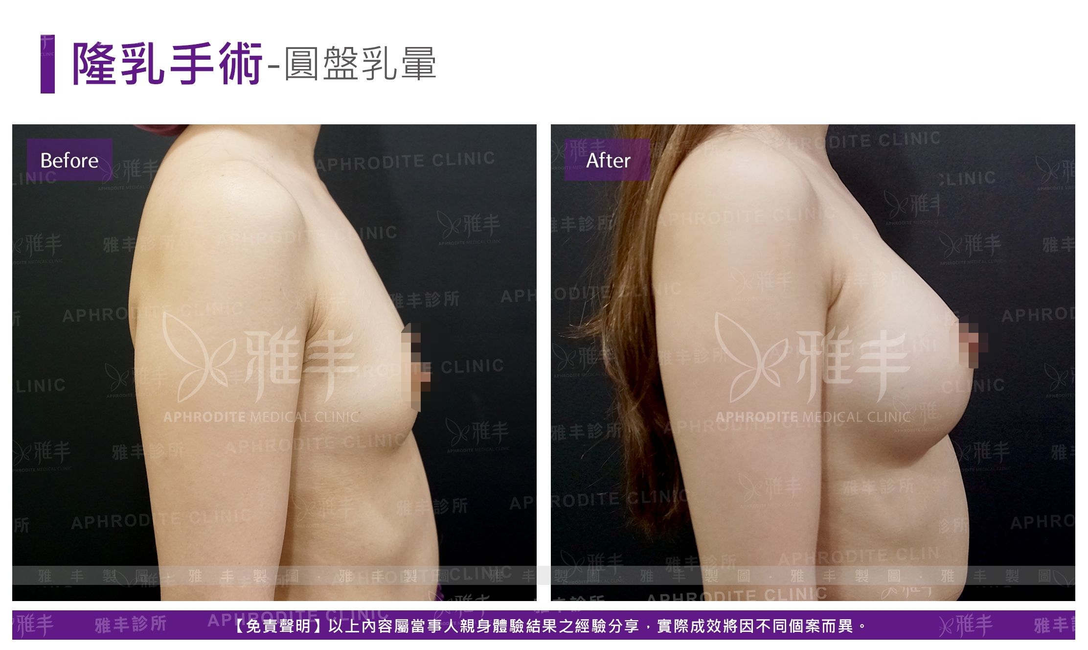 隆乳手術-圓盤乳暈(Case11-R90)