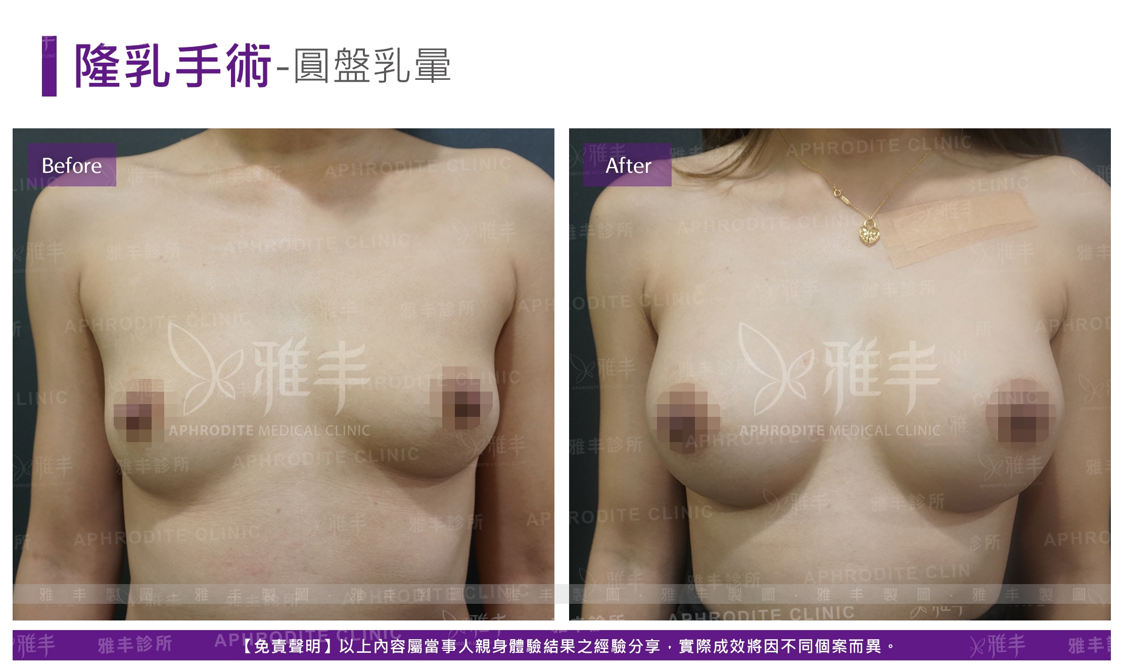 隆乳手術-圓盤乳暈(Case12)