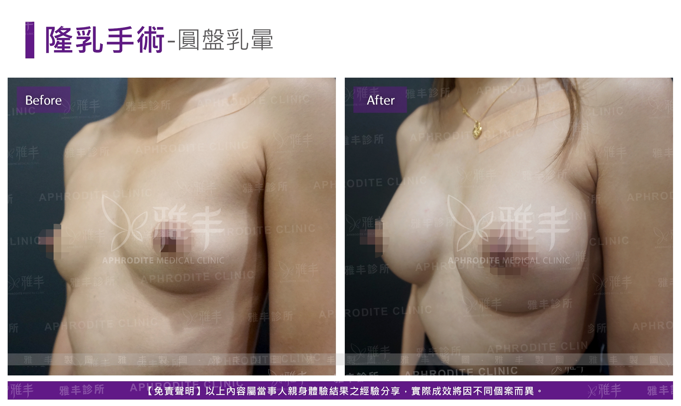 隆乳手術-圓盤乳暈(Case12-L45)