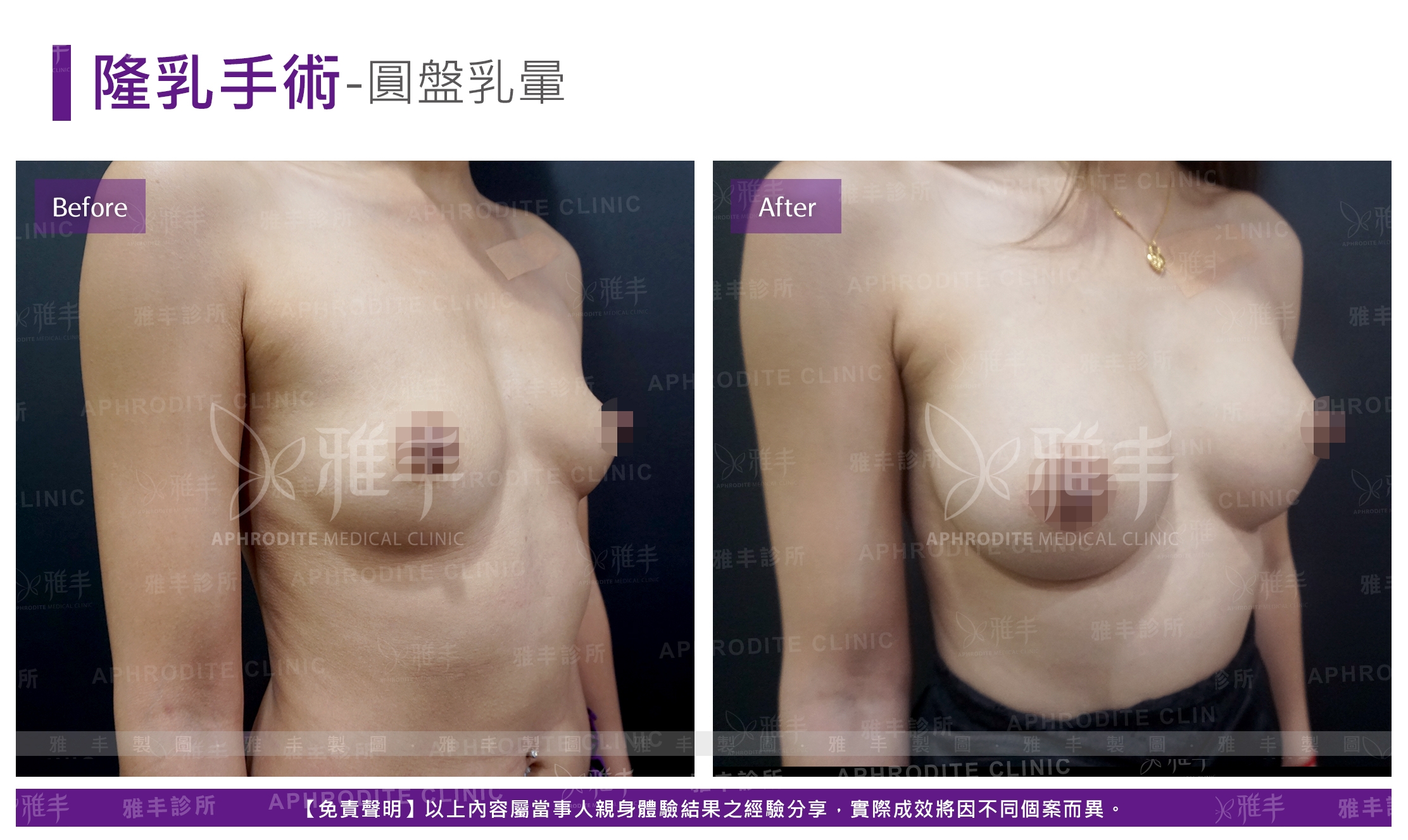 隆乳手術-圓盤乳暈(Case12-R45)
