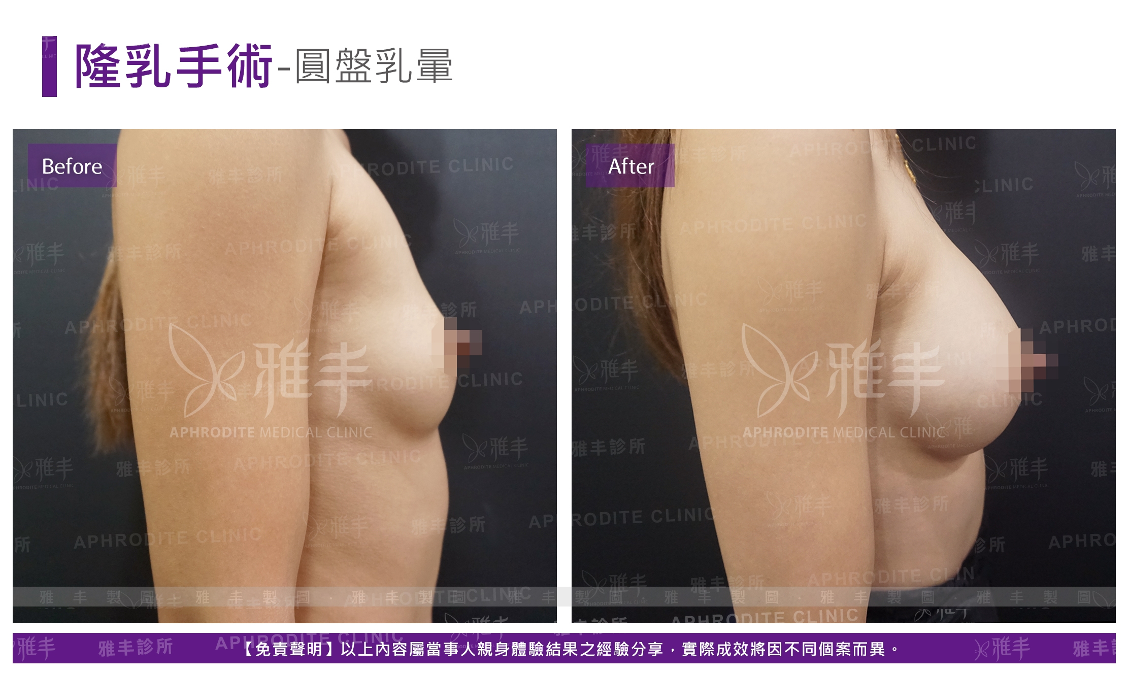 隆乳手術-圓盤乳暈(Case12-R90)