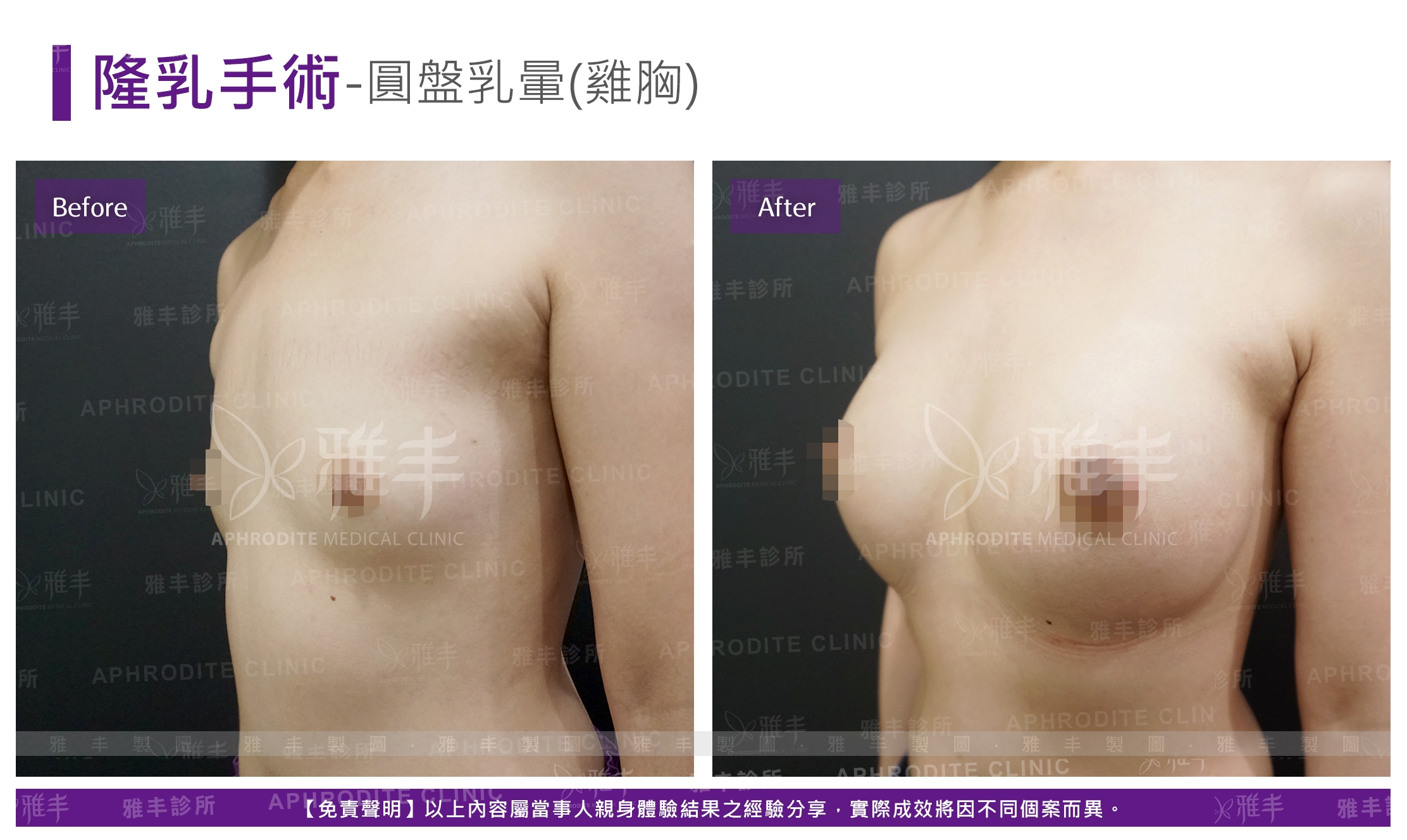隆乳手術-圓盤乳暈(雞胸)(Case13-L45)