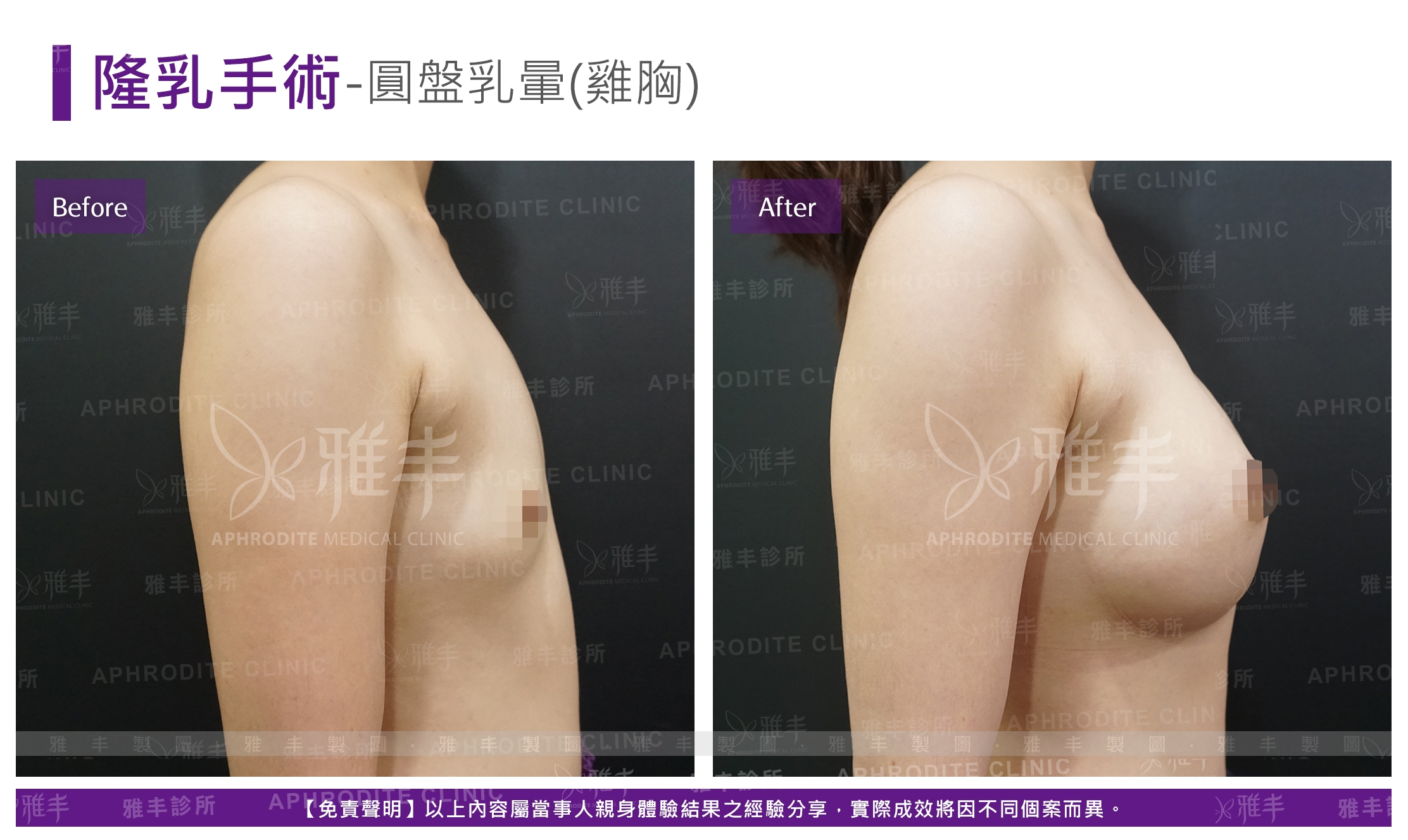 隆乳手術-圓盤乳暈(雞胸)(Case13-L90)