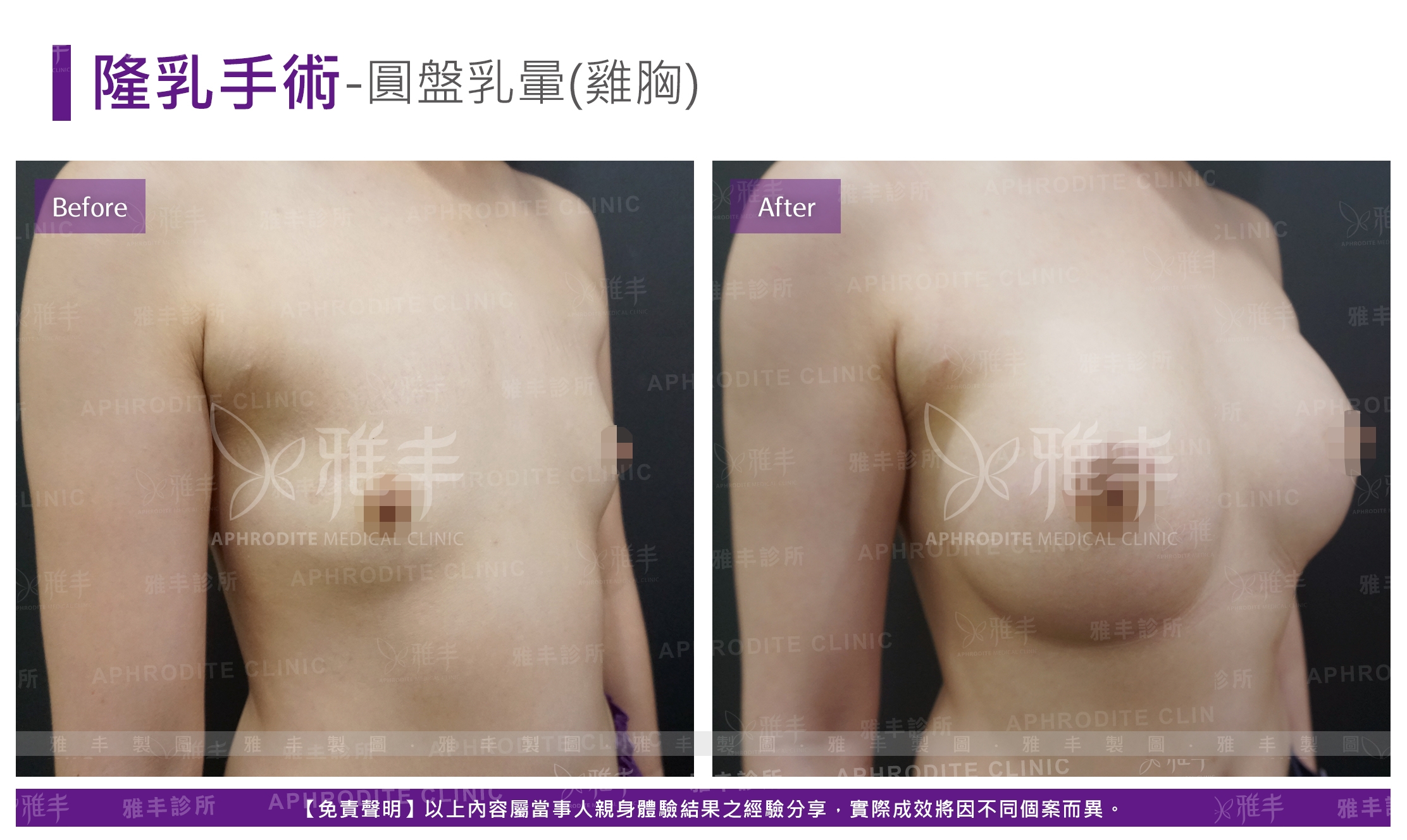 隆乳手術-圓盤乳暈(雞胸)(Case13-R45)
