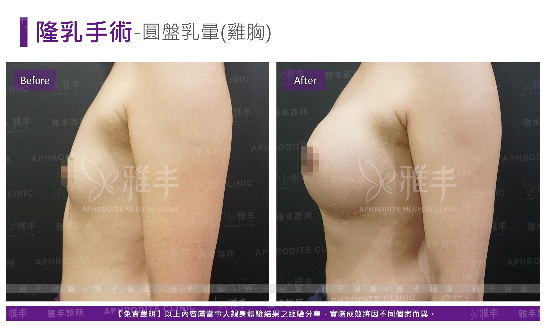 隆乳手術-圓盤乳暈(雞胸)(Case13-R90)