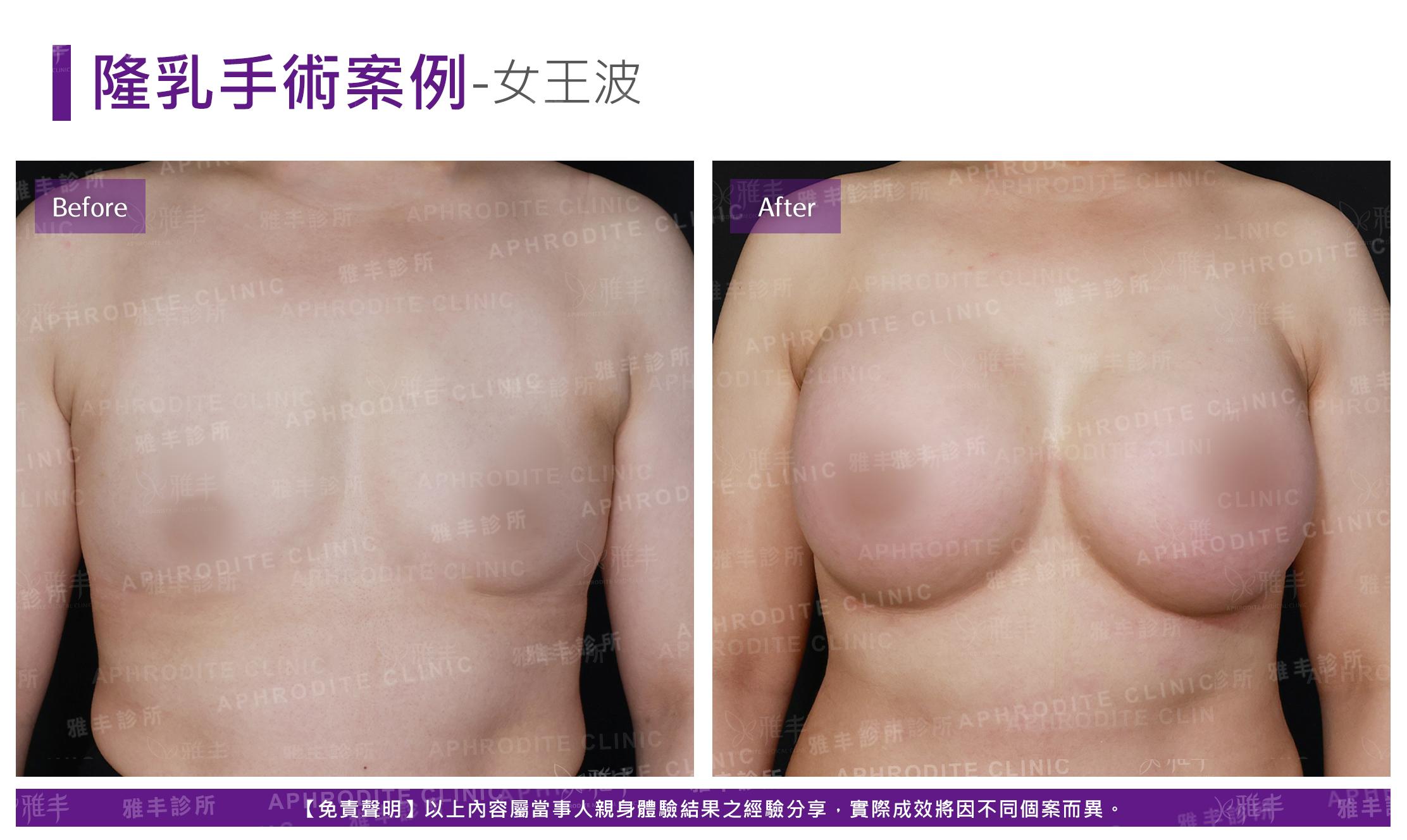 隆乳手術(女王波)-case14-F