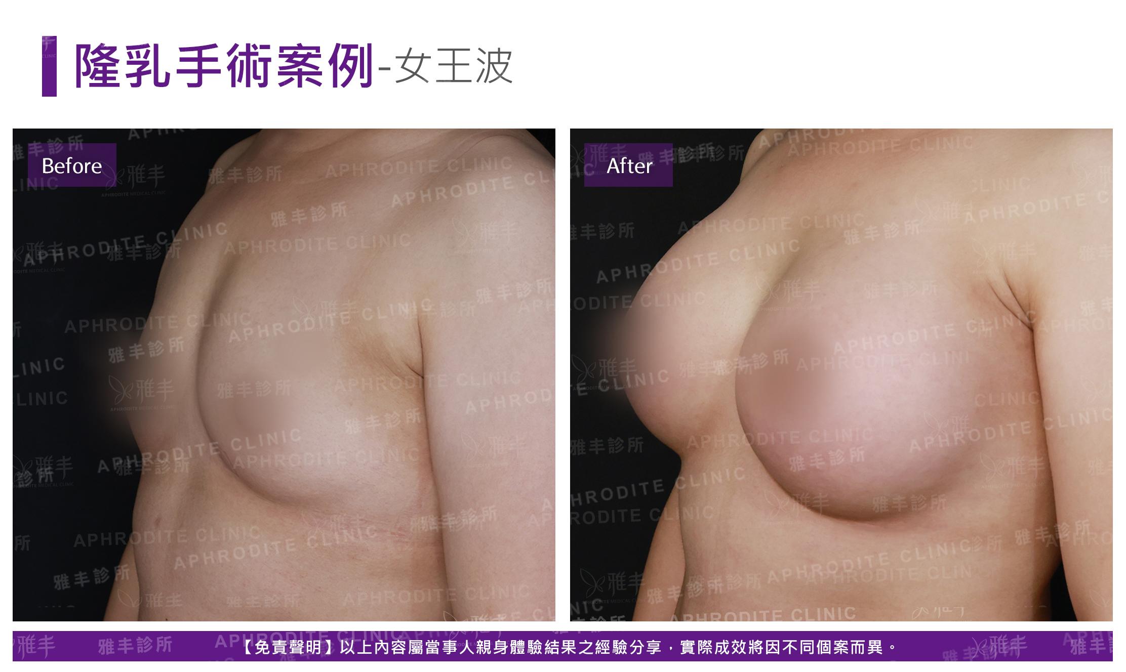 隆乳手術(女王波)-case14-L45