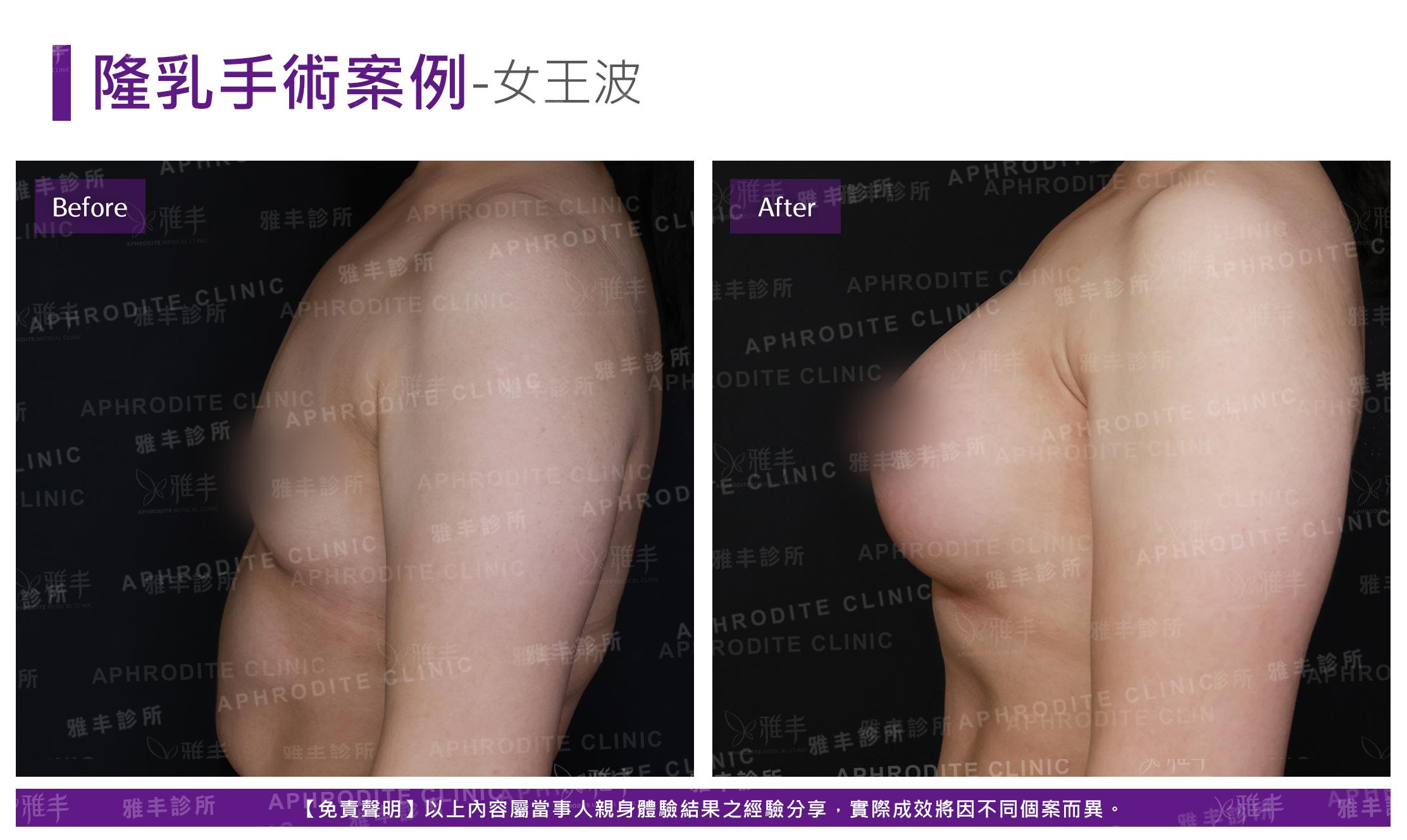 隆乳手術(女王波)-case14-L90