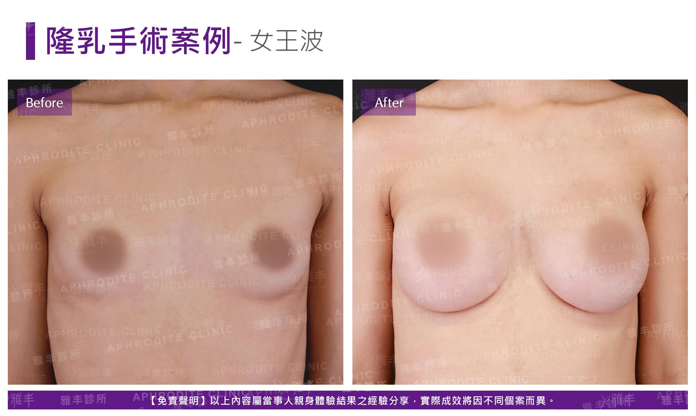 隆乳手術(女王波)-case16-F