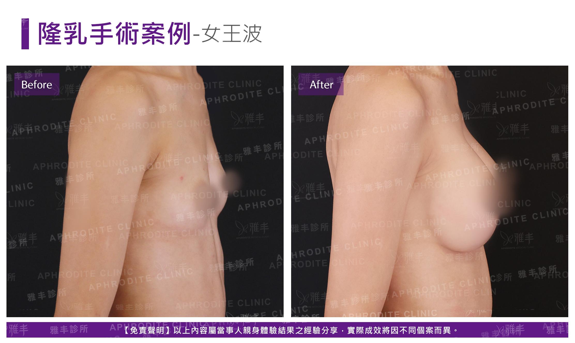 隆乳手術(女王波)-case16-L