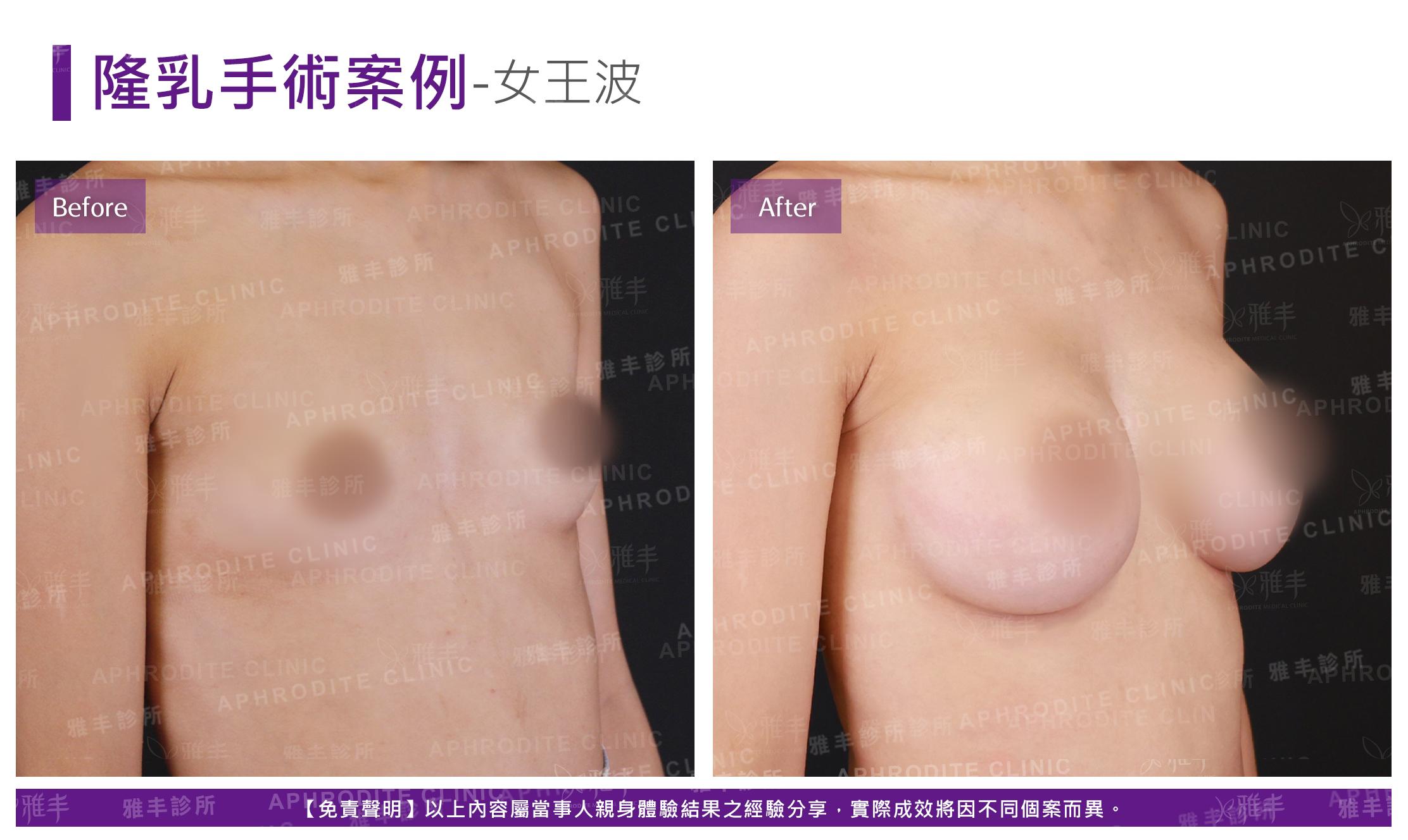 隆乳手術(女王波)-case16-R45