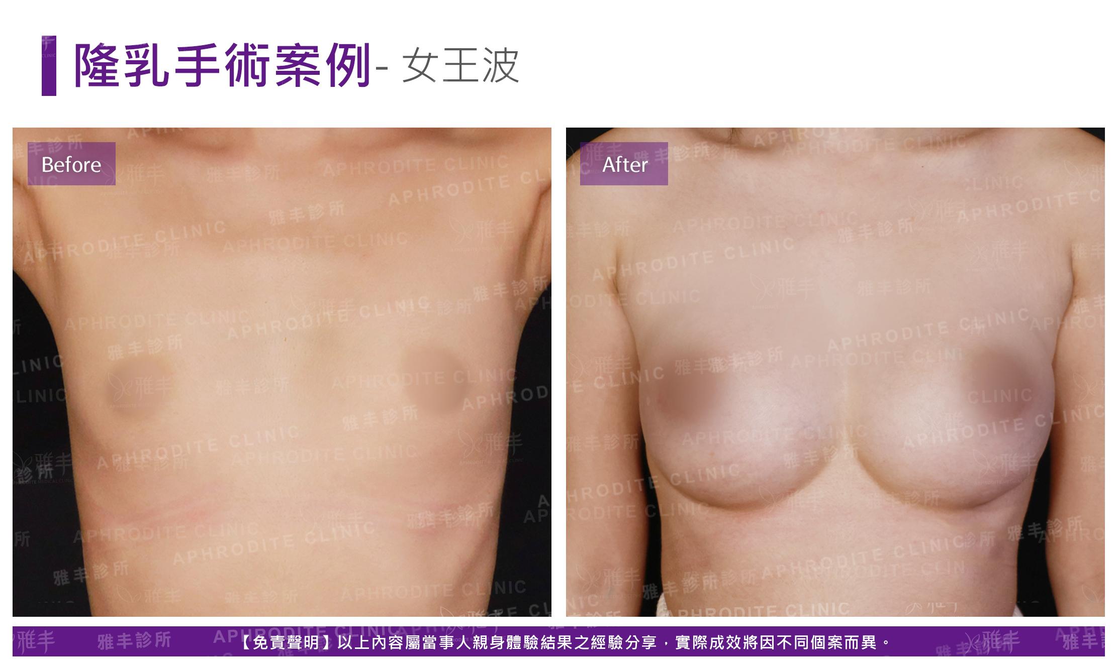 隆乳手術(女王波)-case17-F