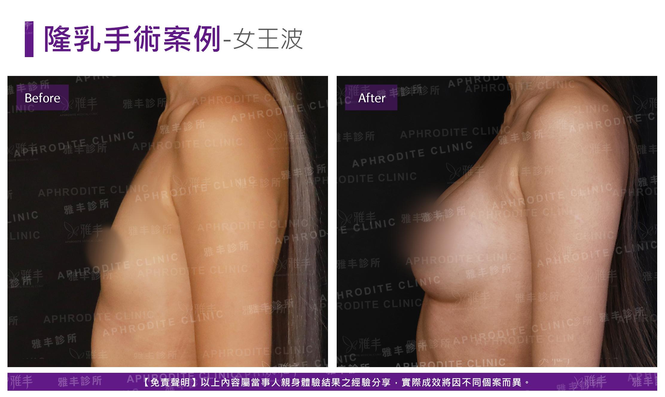 隆乳手術(女王波)-case17-L90