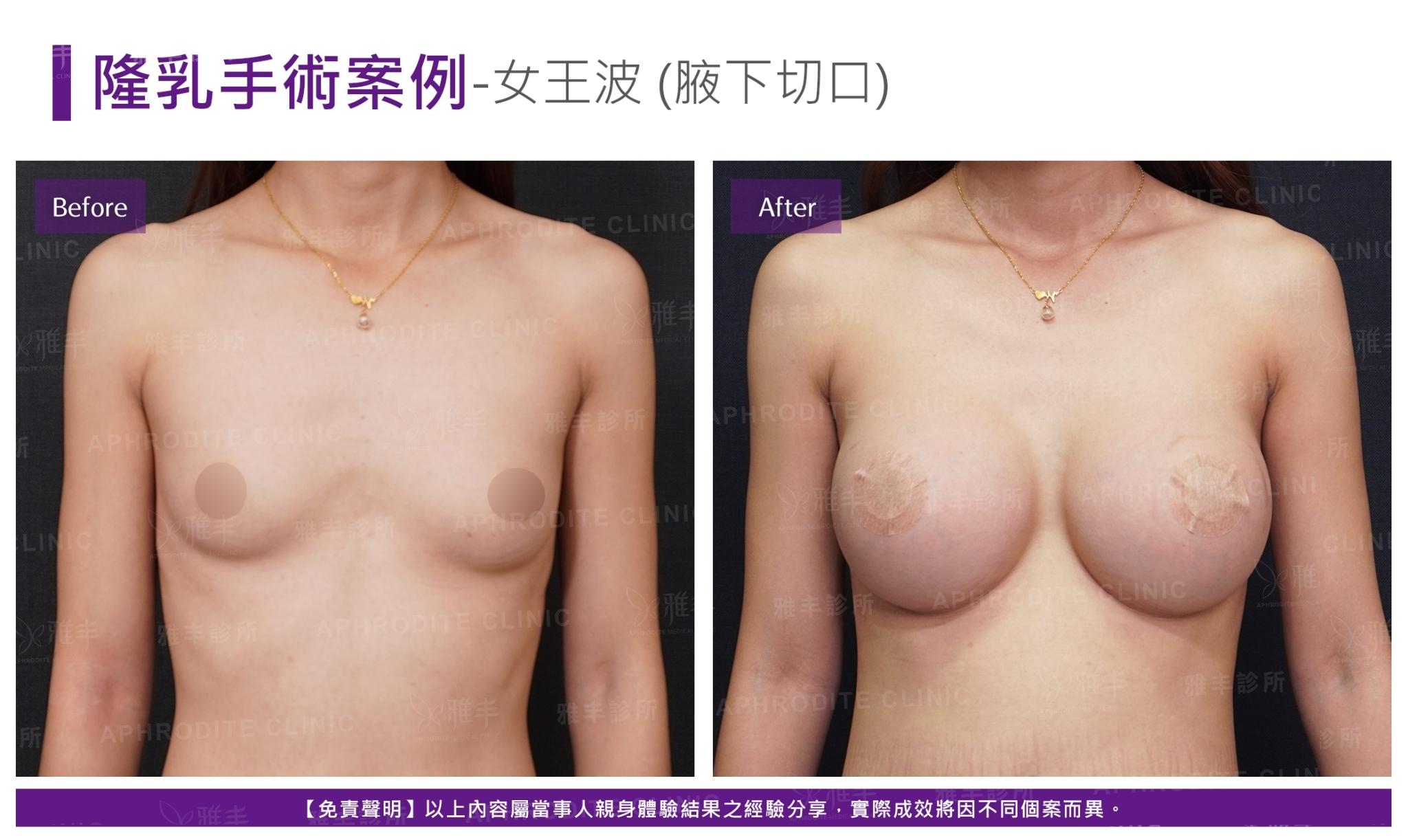S-2-1-2-case18-F(女王波)