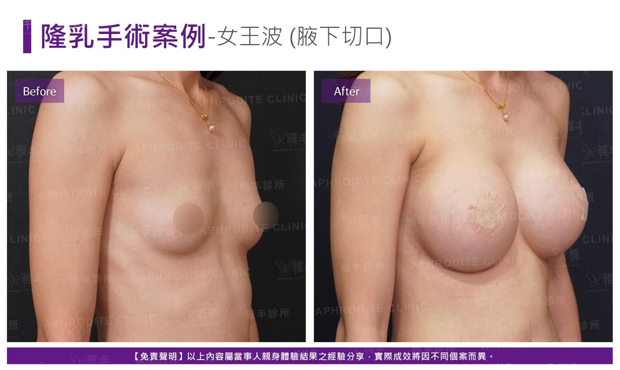 S-2-1-2-case18-R45(女王波)