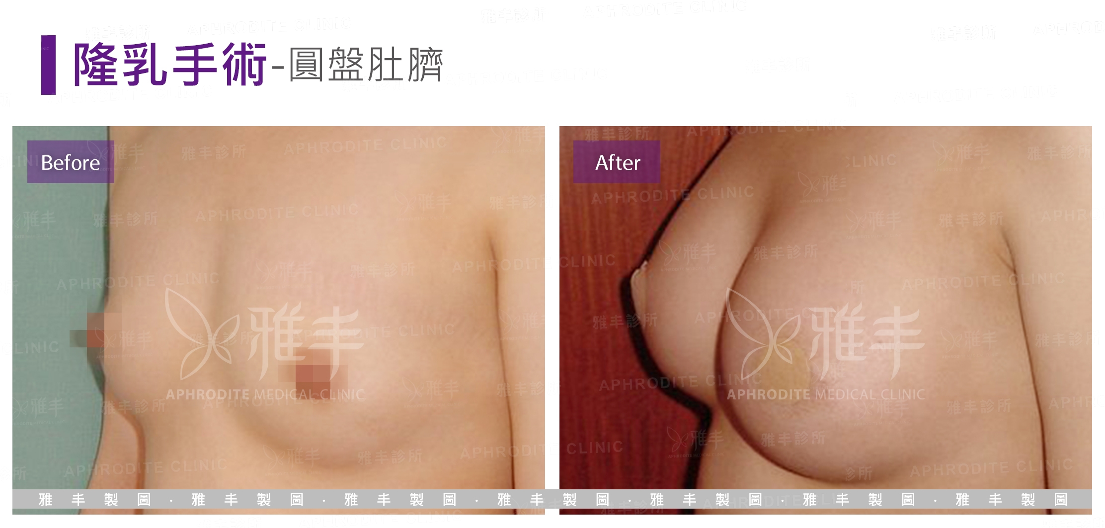 隆乳手術-圓盤肚臍(Case2-L45)