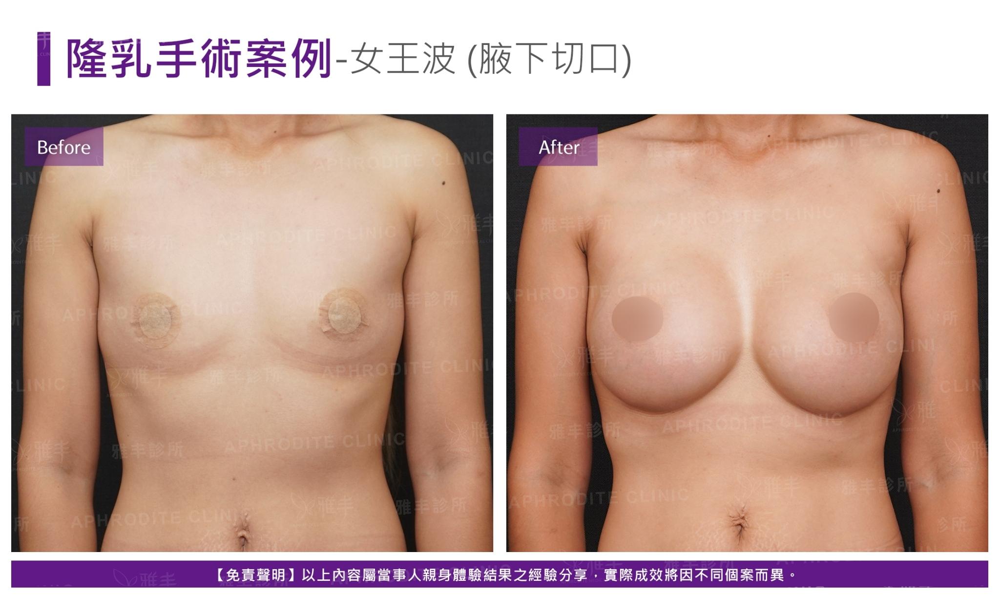 S-2-1-2-case20-F(女王波)