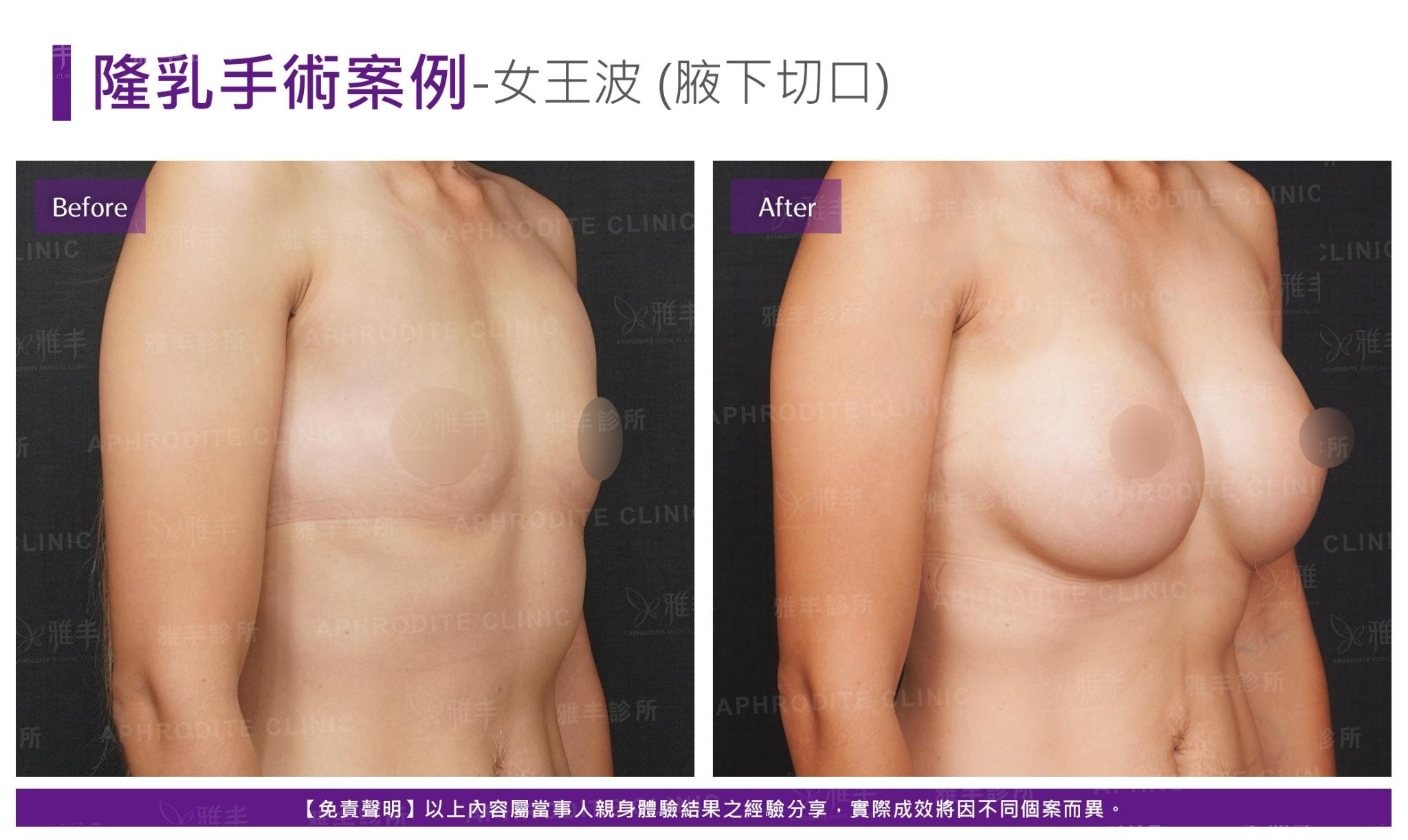S-2-1-2-case20-R45(女王波)