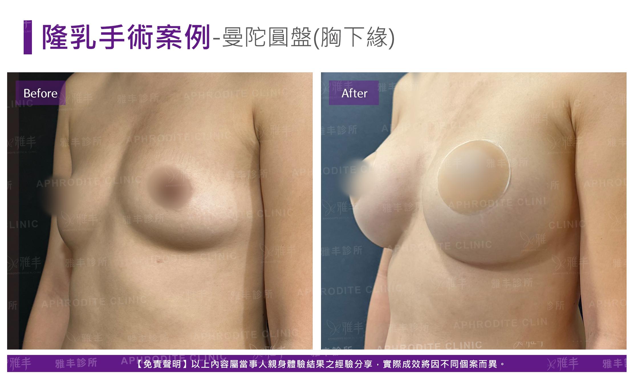 隆乳手術-case22-L45(果凍).jpg