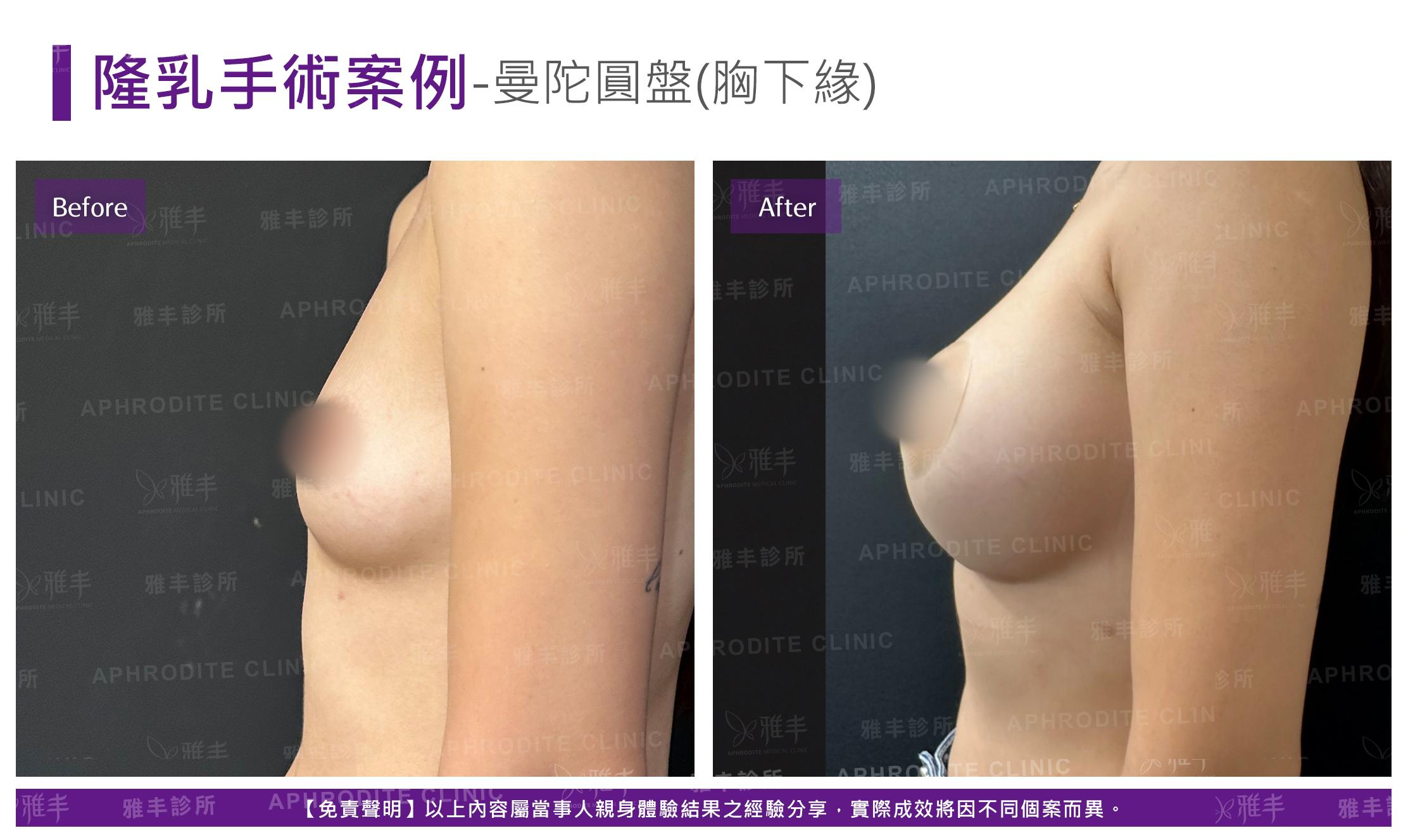 隆乳手術-case22-L90(果凍).jpg