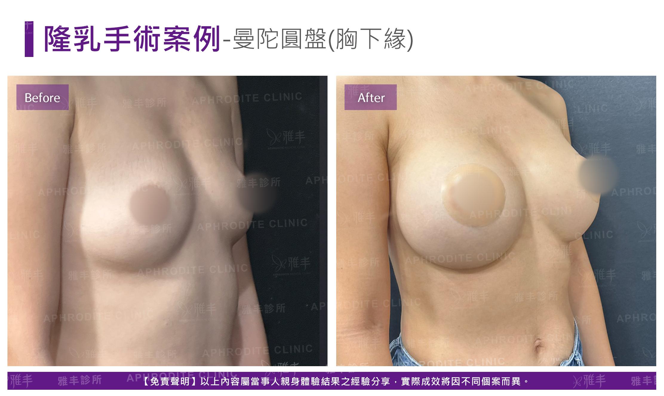 隆乳手術-case22-R45(果凍).jpg