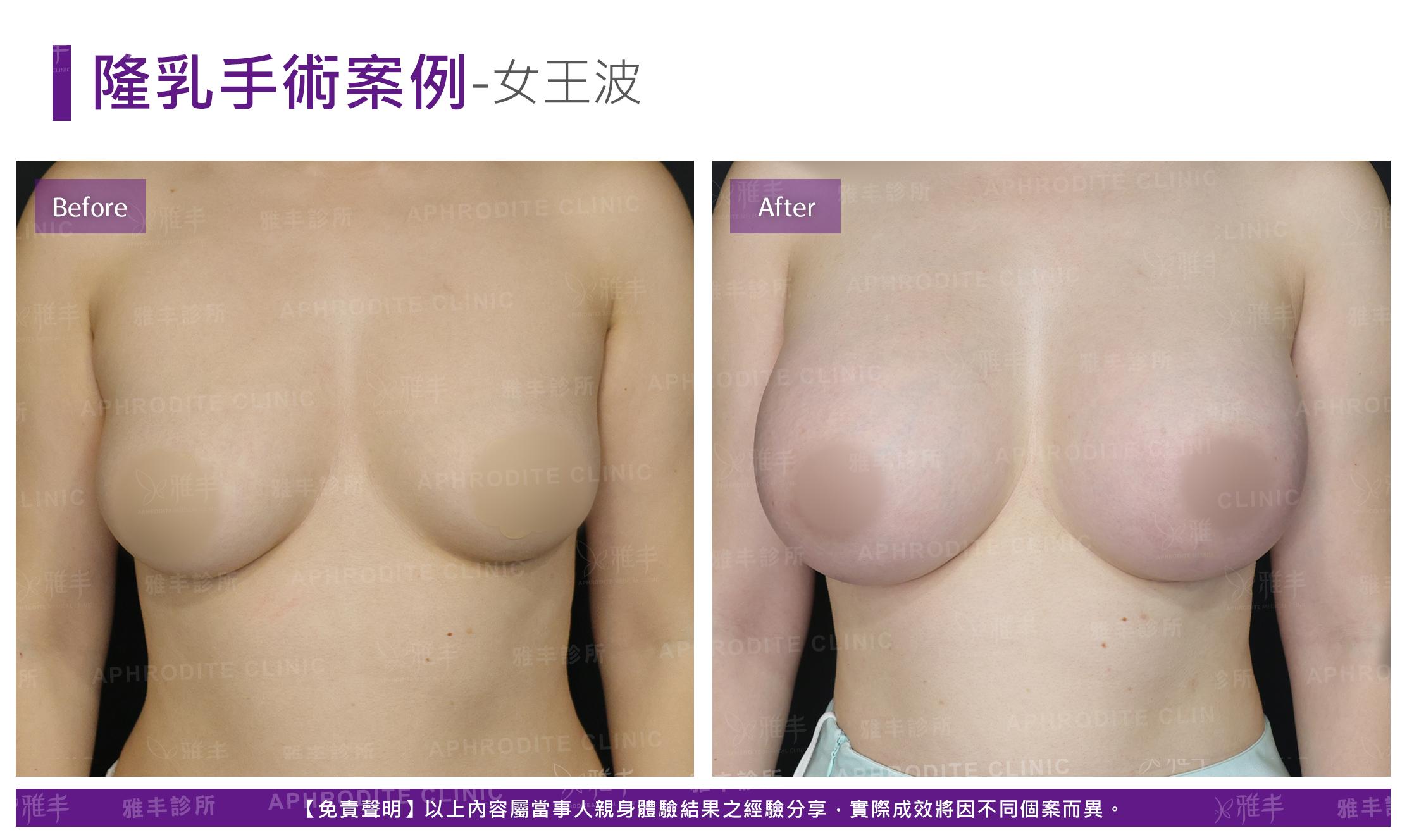 隆乳手術-case23-F.jpg