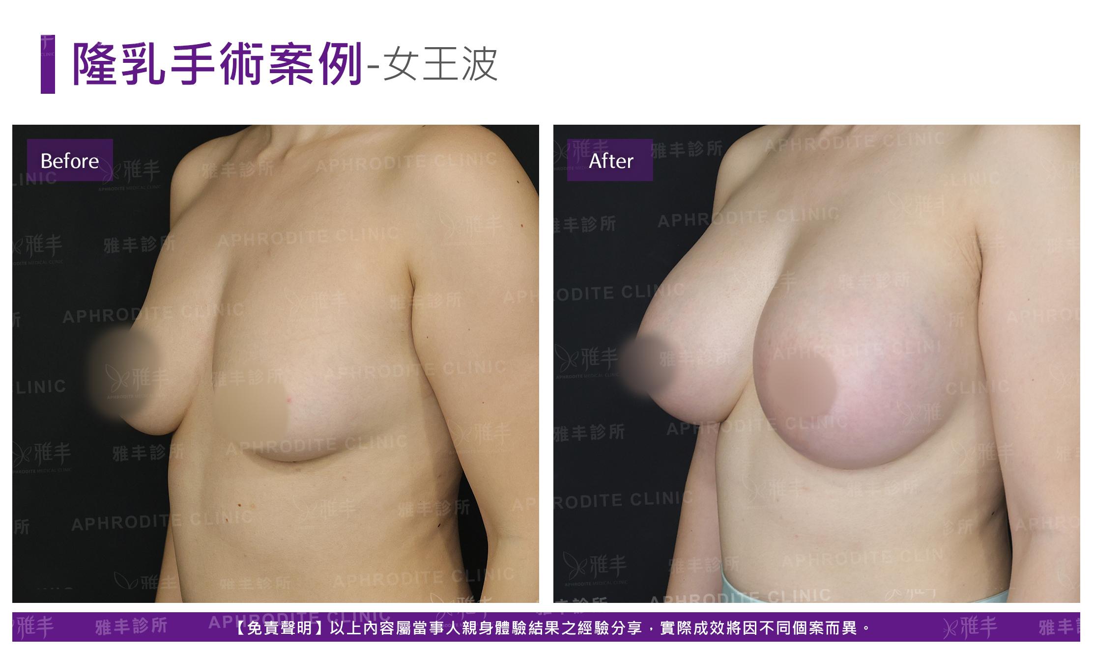 3D列印下巴-case23-L45.jpg
