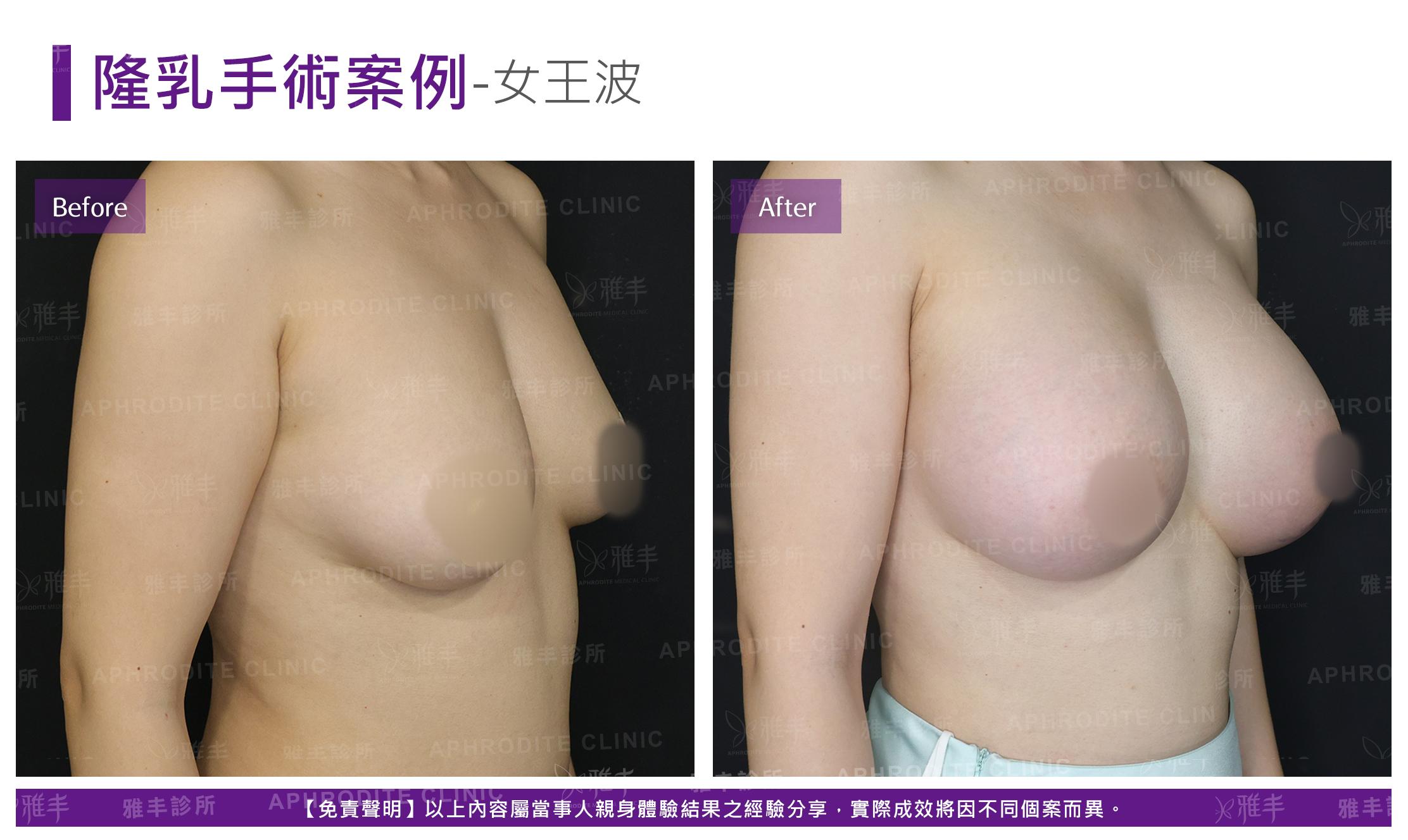 隆乳手術-case23-L45.jpg