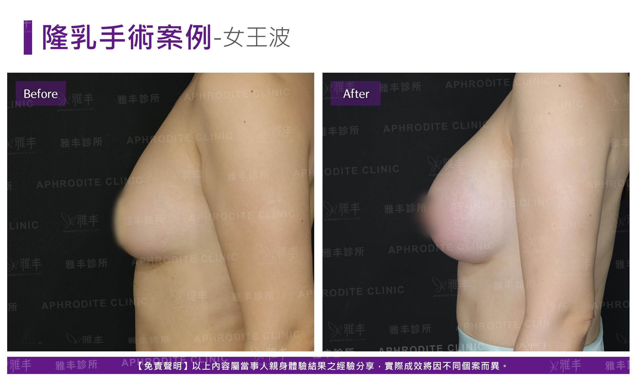 隆乳手術-case23-L90.jpg