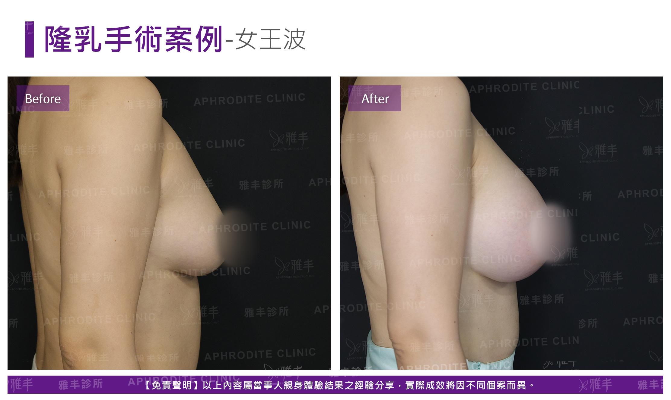 隆乳手術-case23-R90.jpg