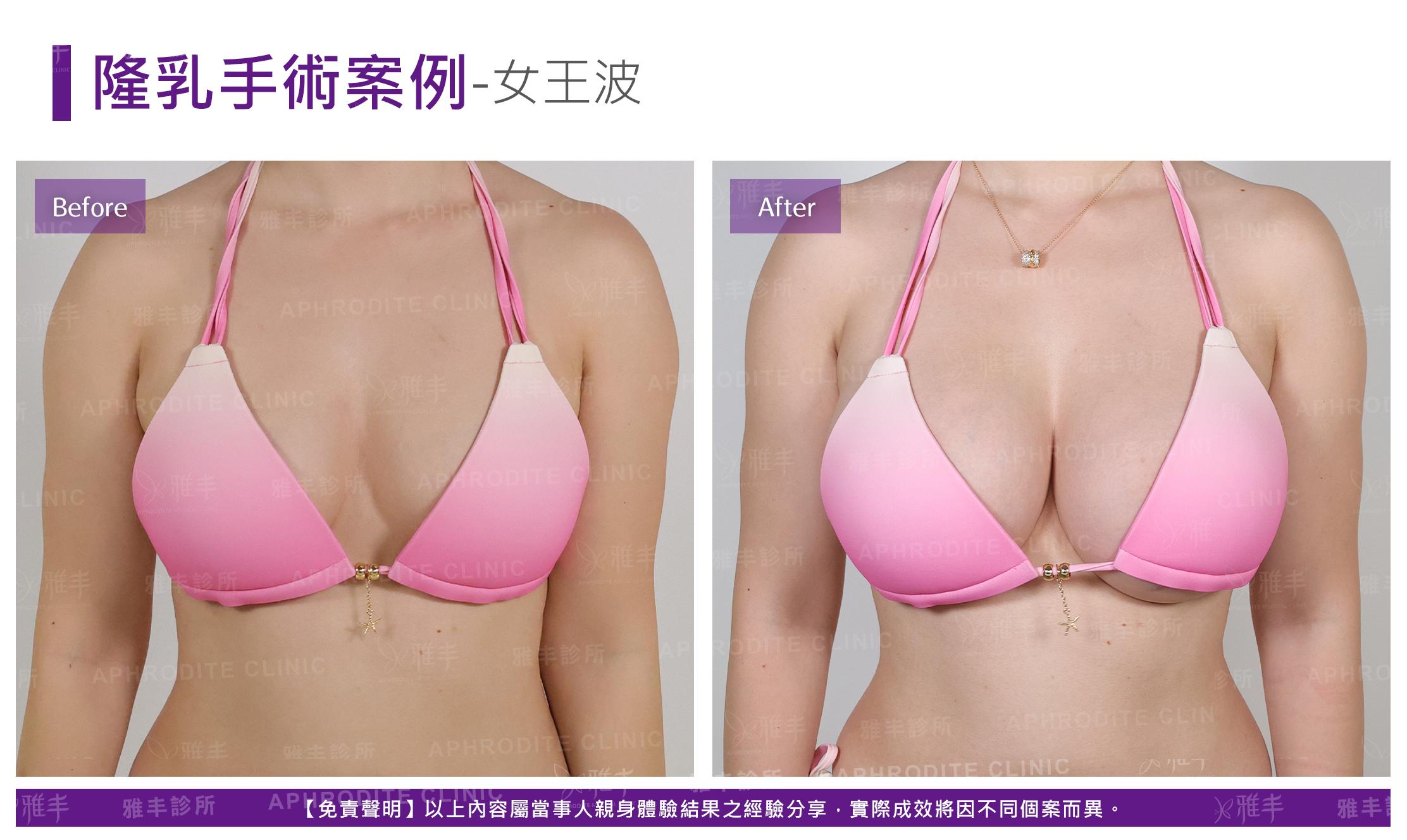 隆乳手術-case24-F.jpg