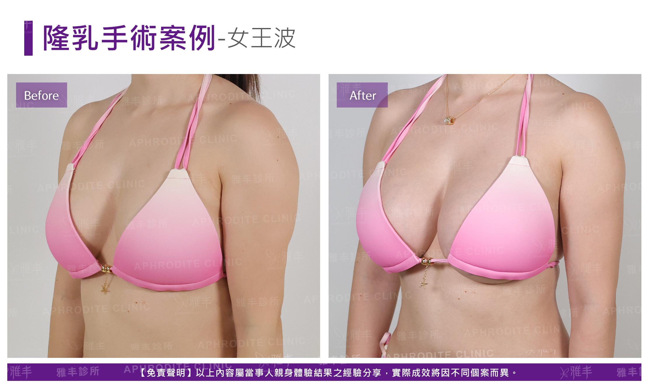 隆乳手術-case24-L45.jpg