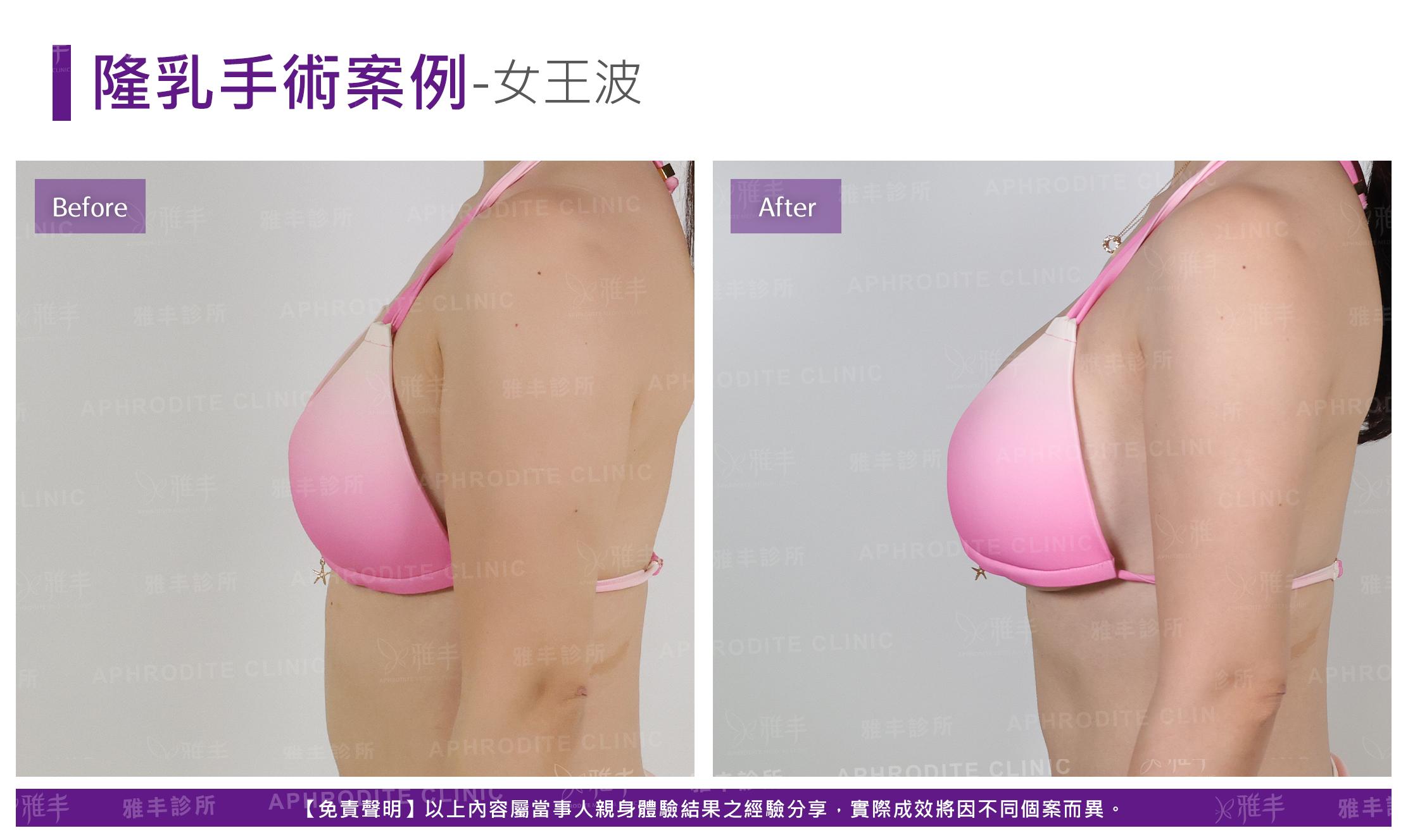 隆乳手術-case24-L90.jpg