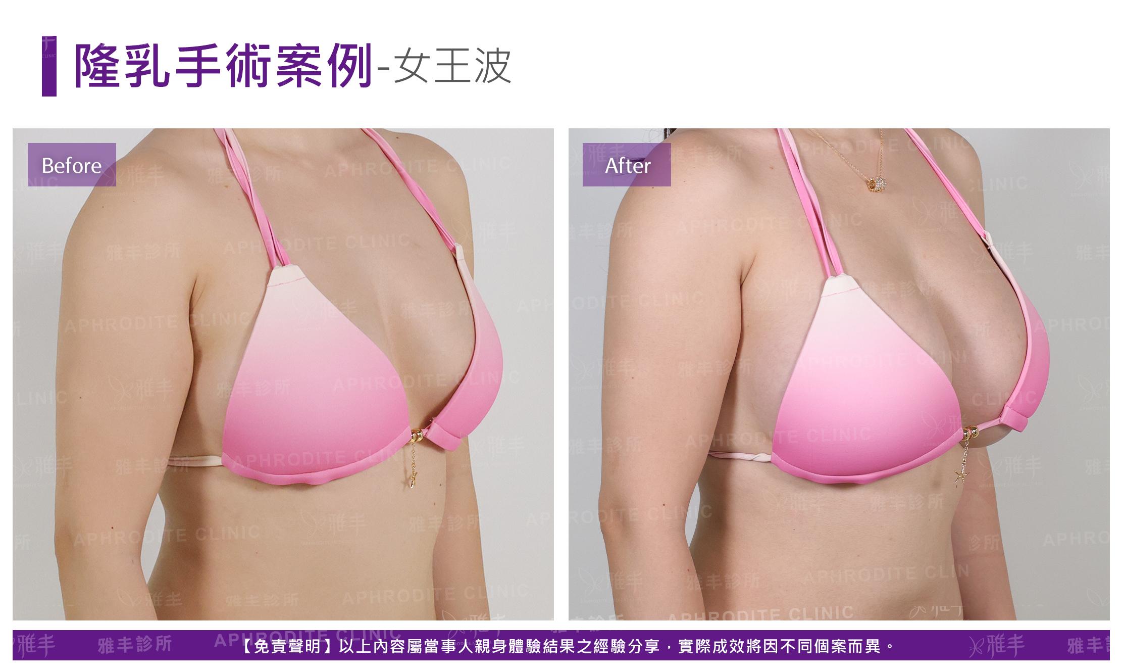 隆乳手術-case24-R45.jpg