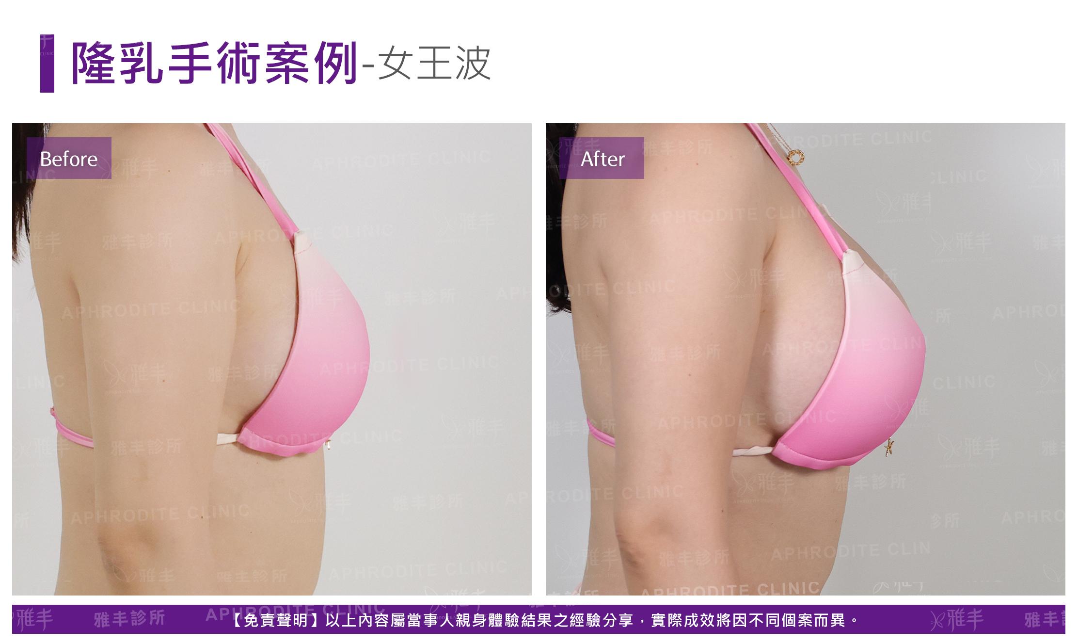 隆乳手術-case24-R90.jpg