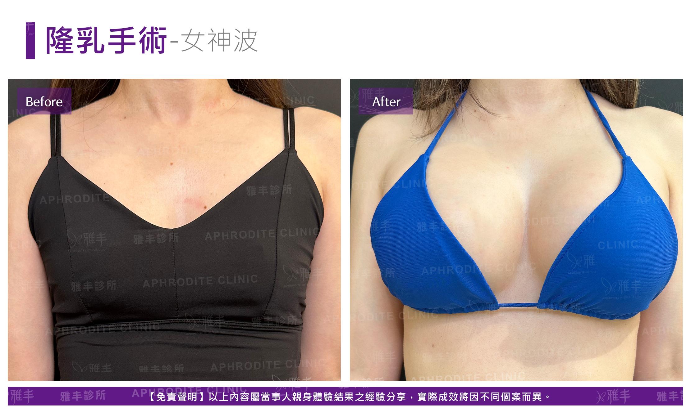 隆乳手術-case25-F.jpg