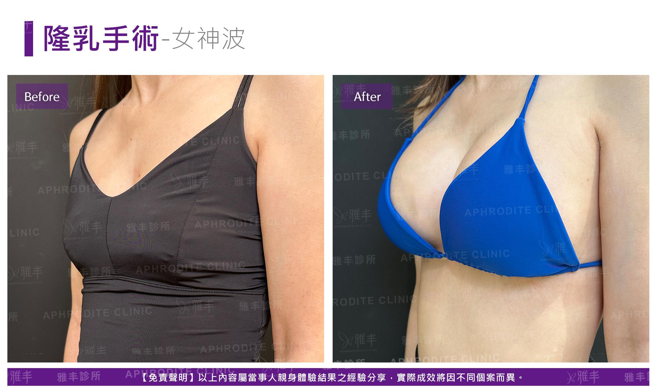 隆乳手術-case25-L45.jpg