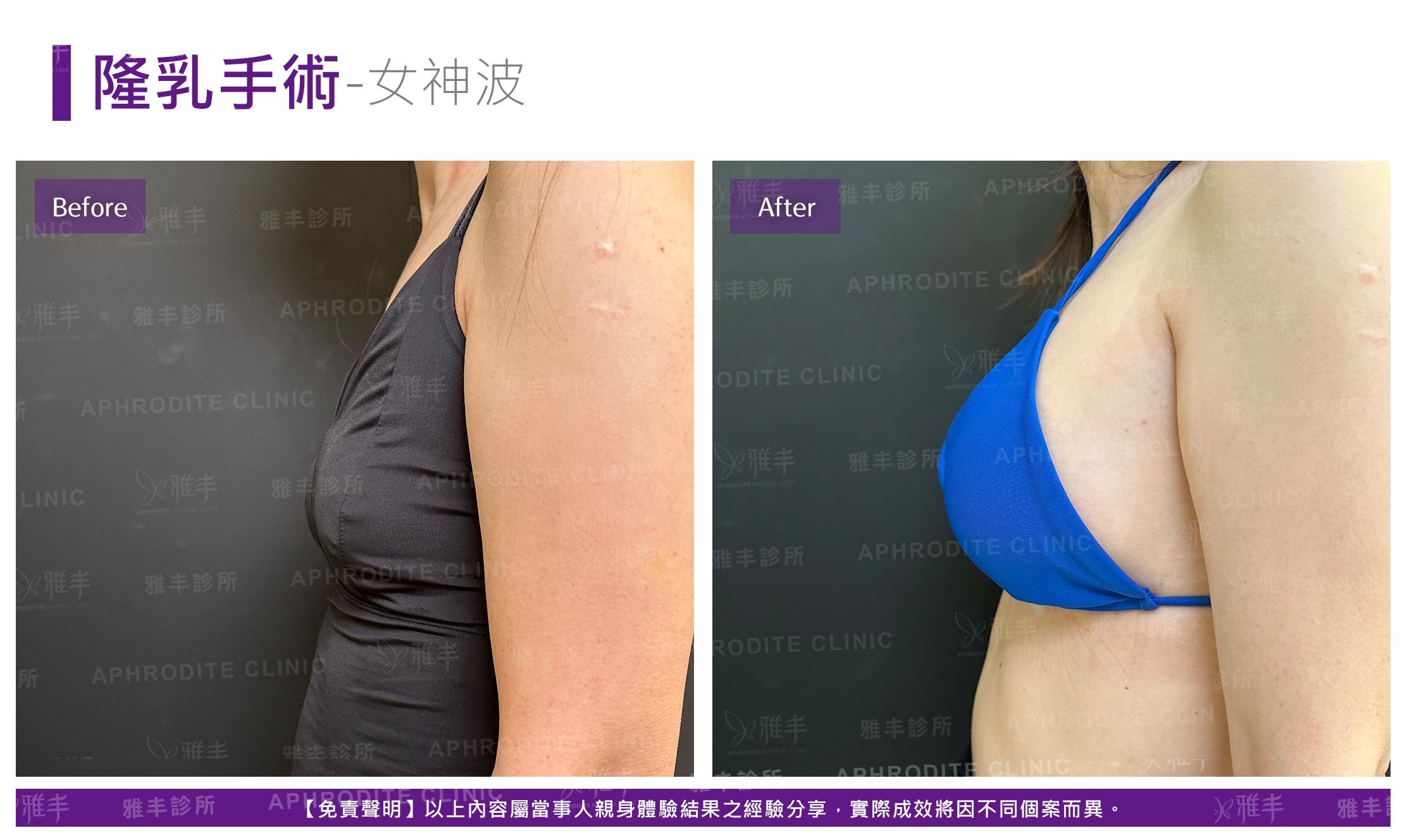 隆乳手術-case25-L90.jpg