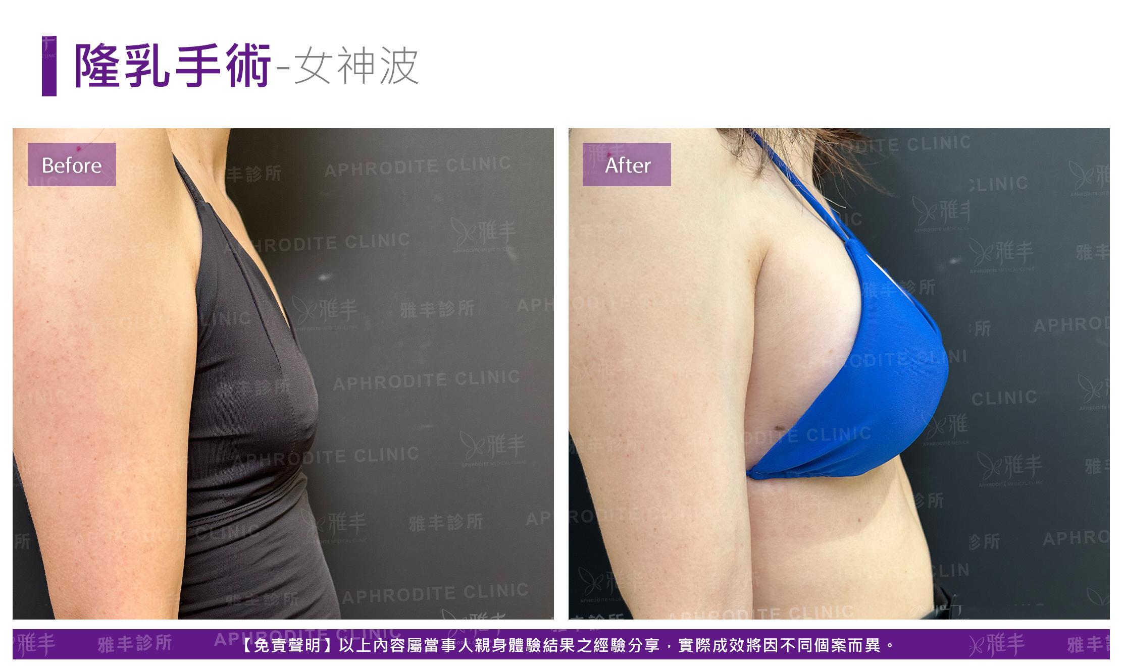 隆乳手術-case25-R90.jpg